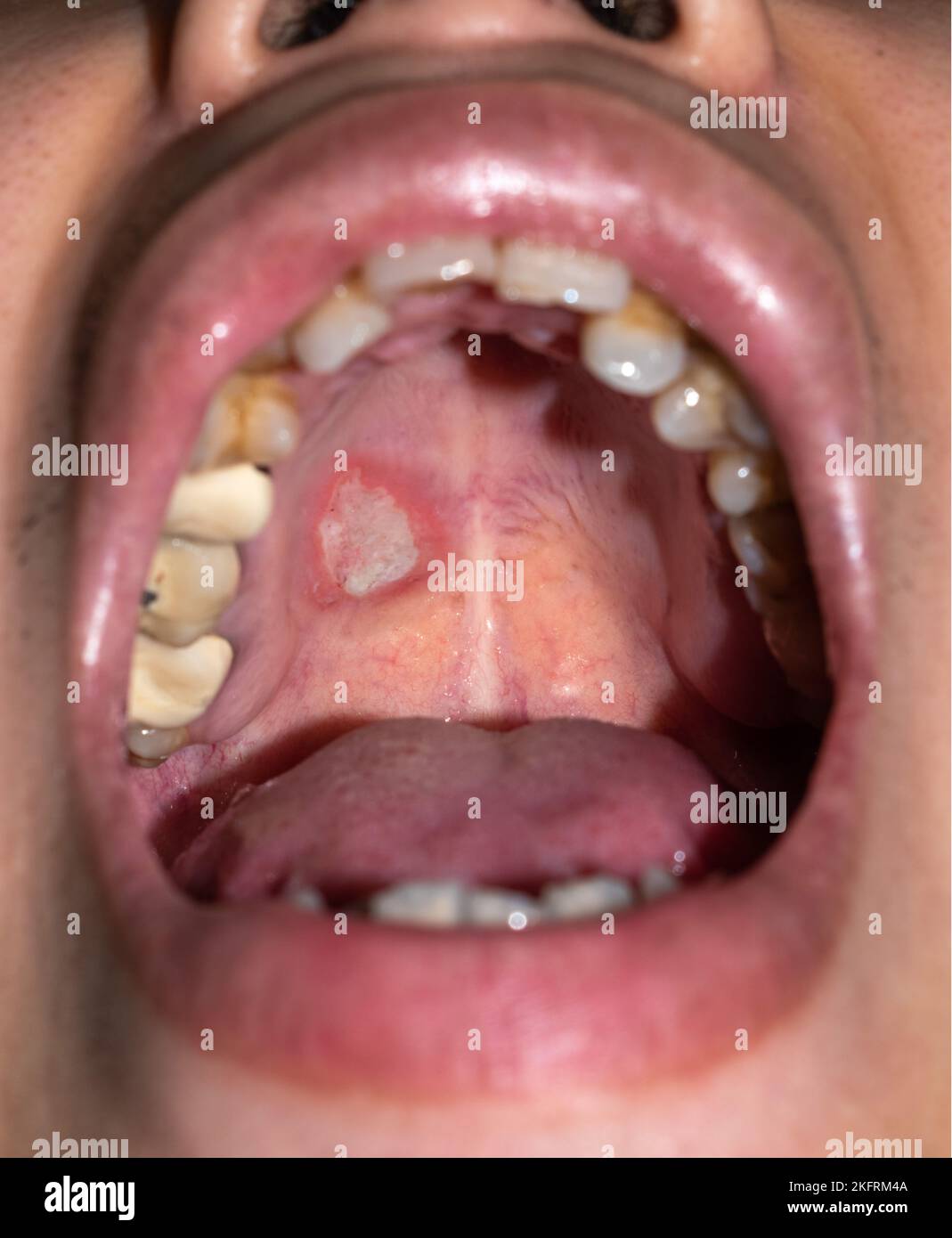 Ulcera aftosa o ulcera da stress nella bocca di pazienti asiatici maschi. Foto Stock