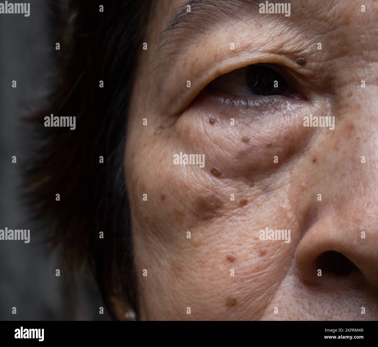 Piccole macchie marroni chiamate macchie di età sul volto della donna anziana asiatica. Sono anche chiamati macchie di fegato, lentigo senile, o macchie di sole. Primo piano. Foto Stock