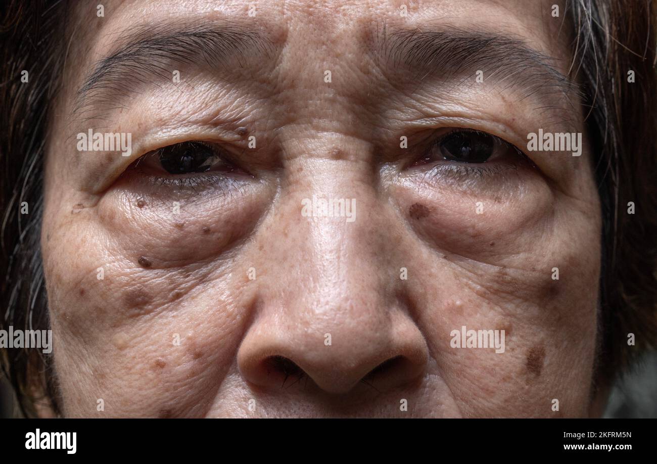 Piccole macchie marroni chiamate macchie di età sul volto della donna anziana asiatica. Sono anche chiamati macchie di fegato, lentigo senile, o macchie di sole. Primo piano. Foto Stock