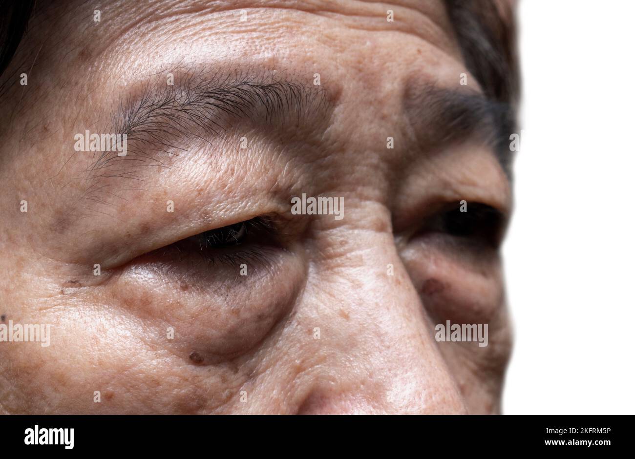 Sacco grasso prominente sotto l'occhio della donna anziana asiatica. Primo piano. Foto Stock