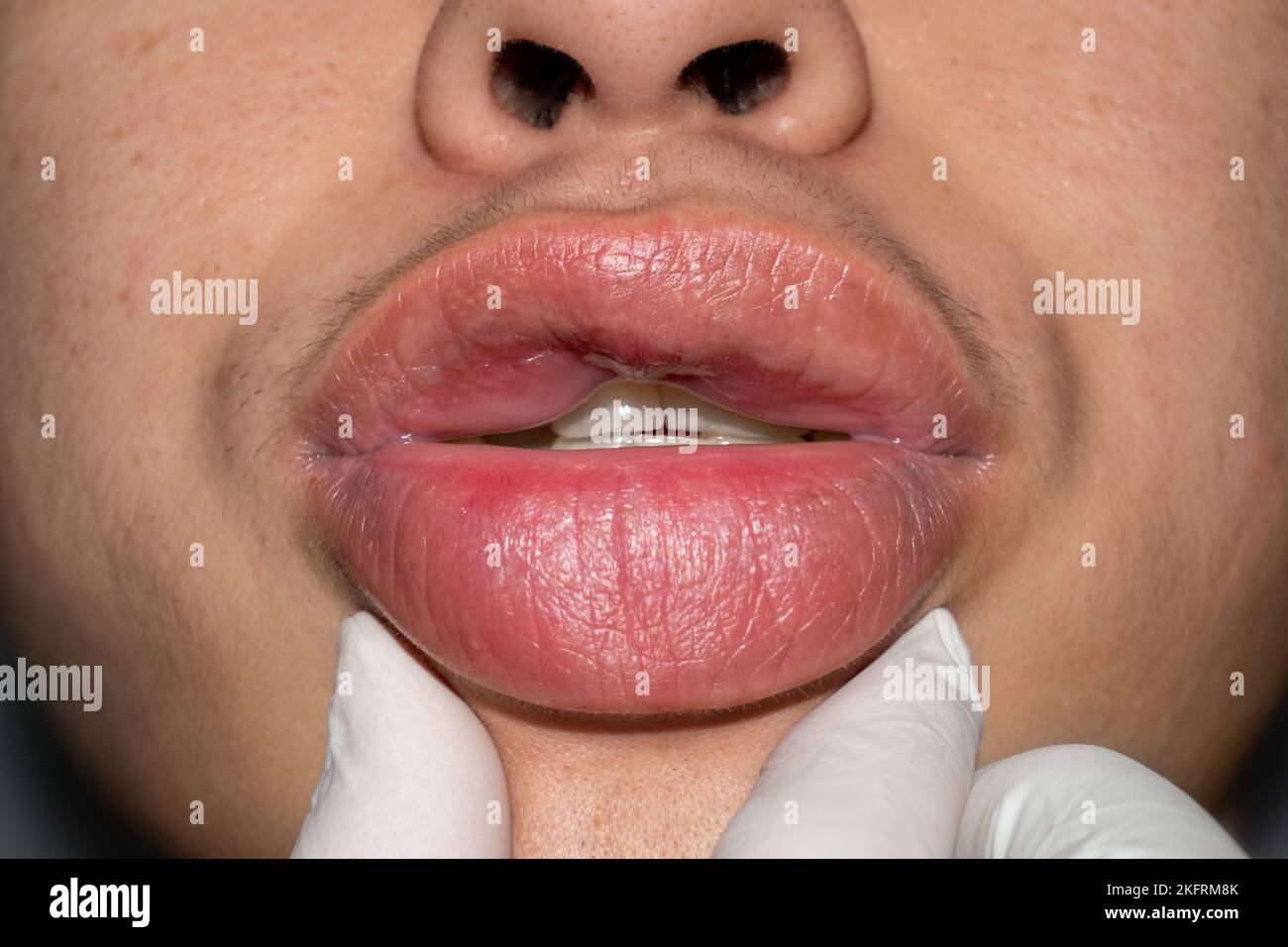 Labbra gonfie immagini e fotografie stock ad alta risoluzione - Alamy