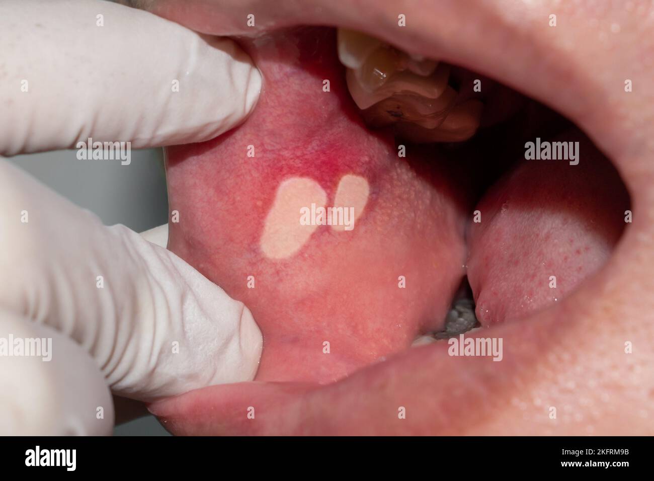 Ulcera aftosa o ulcera da stress nella bocca di pazienti asiatici maschi. Foto Stock