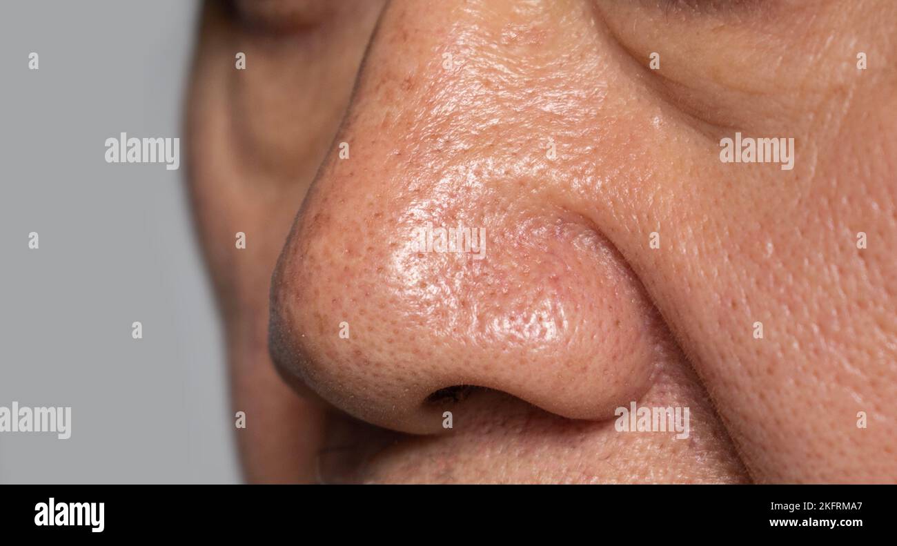 Allargando i pori nel naso del vecchio asiatico. Foto Stock