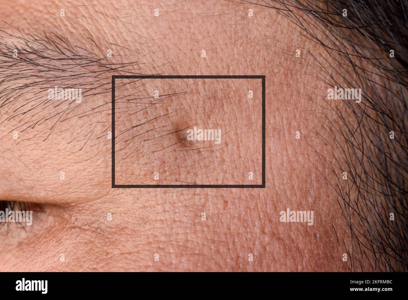 Singola cicatrice dell'acne sulla faccia dell'uomo cinese asiatico. Foto Stock