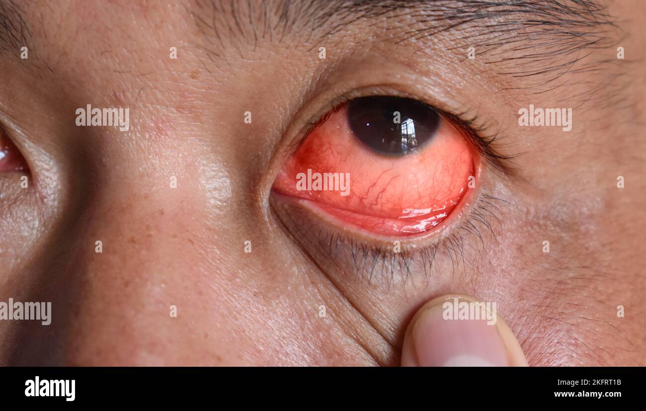 Infezione corneale o ulcera chiamata cheratite nell'uomo asiatico cinese. Foto Stock