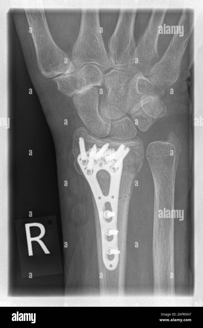 Radiografia di un paziente con frattura distale radiale a destra con avulsione PSU, stabilizzata mediante osteosintesi della piastra con plat angolare stabile Foto Stock