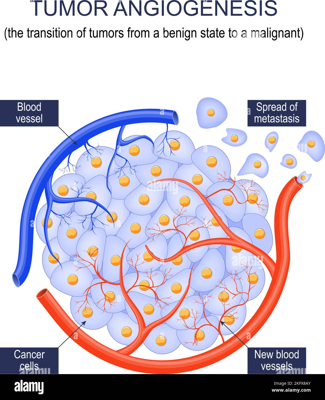 Angiogenesi tumorale passaggio dei tumori da uno stato benigno a uno maligno. Crescita del tumore. Cellule tumorali e diffusione di metastasi. Poster vettoriale Illustrazione Vettoriale