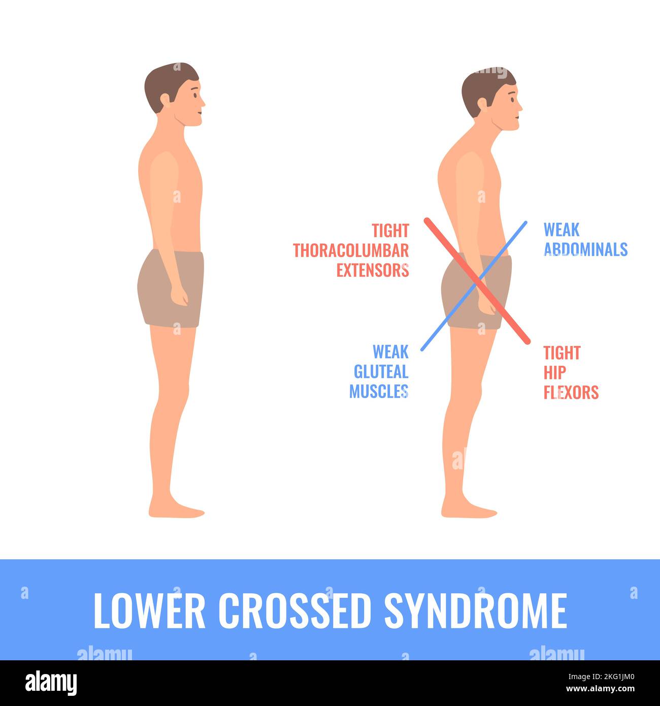 Uomo storto con sbilanciamento della sindrome più bassa incrociata Illustrazione Vettoriale