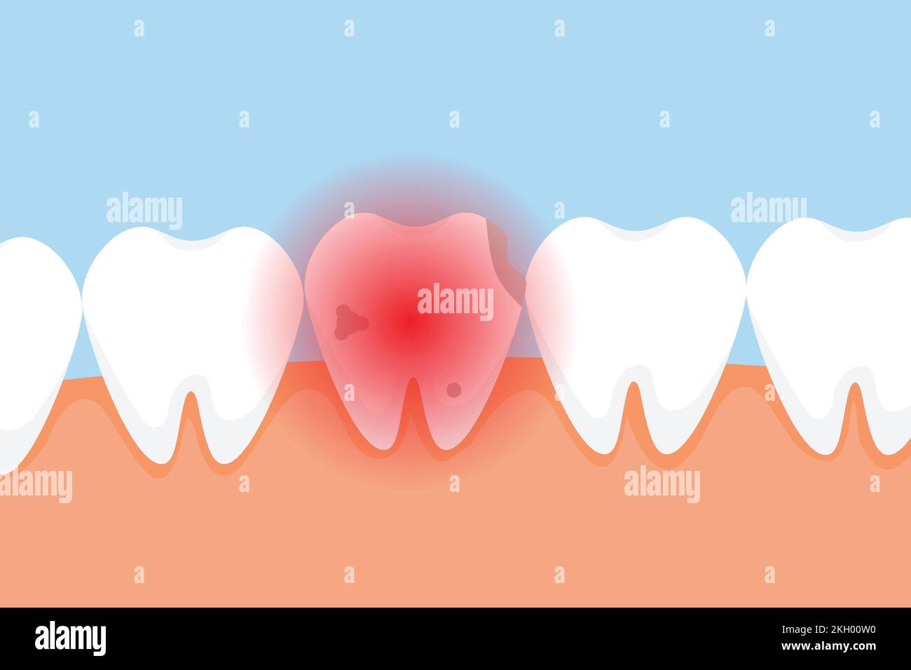 Dente morto che danneggia e dà un concetto di segnale di dolore rosso. Un dente difettoso con cavità e un segnale di pericolo rosso. Vettore di elementi infografici dentali con un Illustrazione Vettoriale