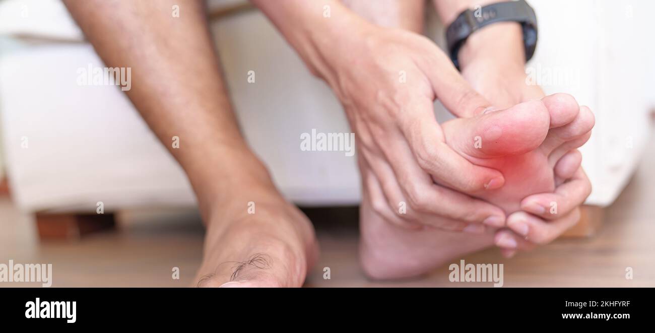 Uomo con dita dei piedi o blister a causa di indossare scarpe strette e svegliarsi o correre lungo, dolore a piedi nudi a causa di fasciite plantare. Salute e medica Foto Stock