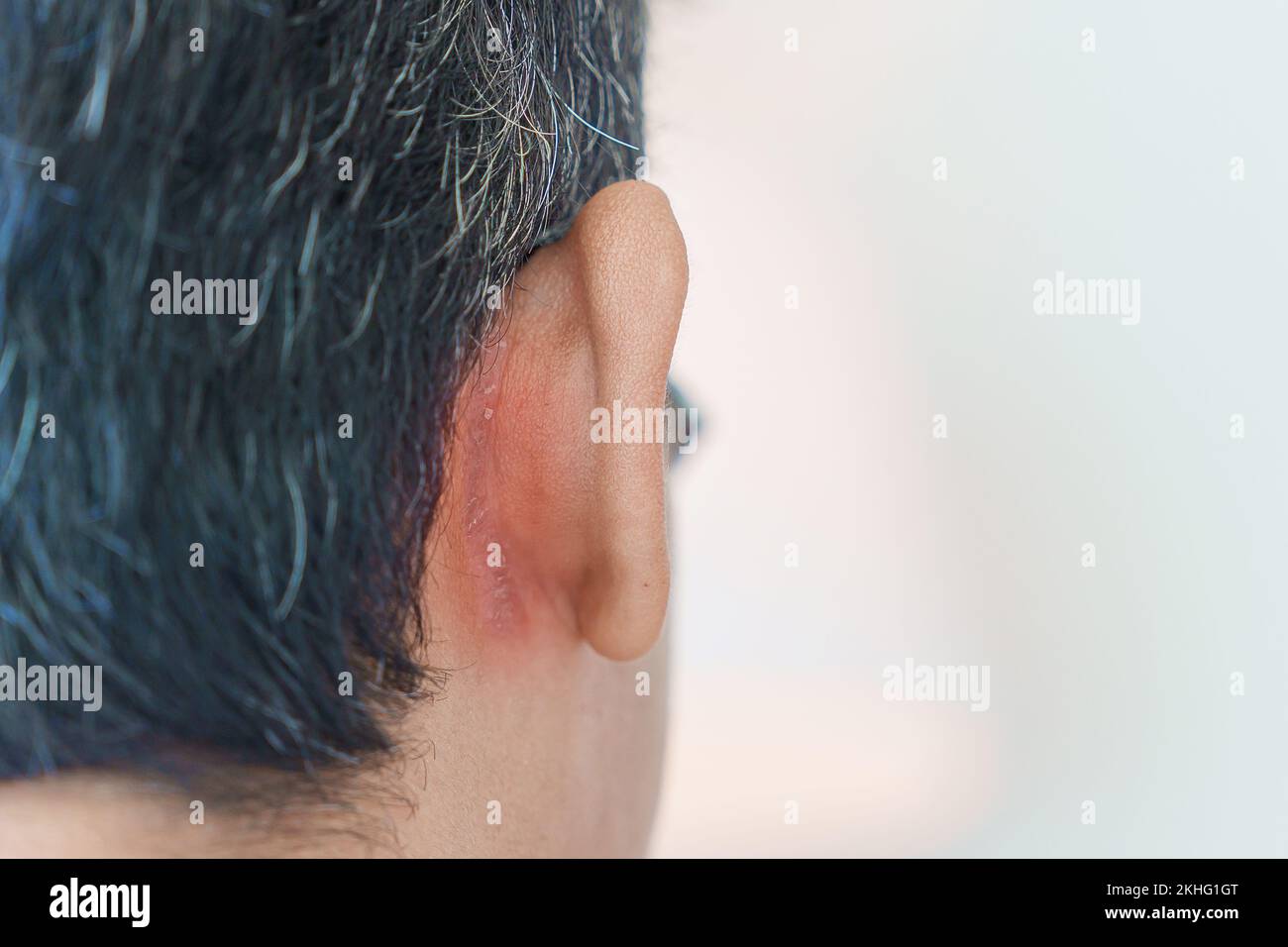 Uomo con problemi all'orecchio dovuti a dermatite seborroica, psoriasi, verme anulare e infezione fungina della pelle Foto Stock