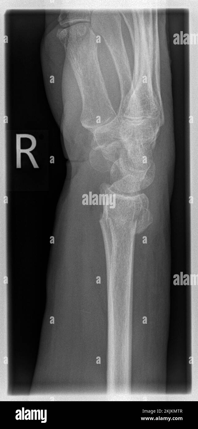 Radiografia di un paziente con frattura distale radiale a destra con avulsione PSU Foto Stock