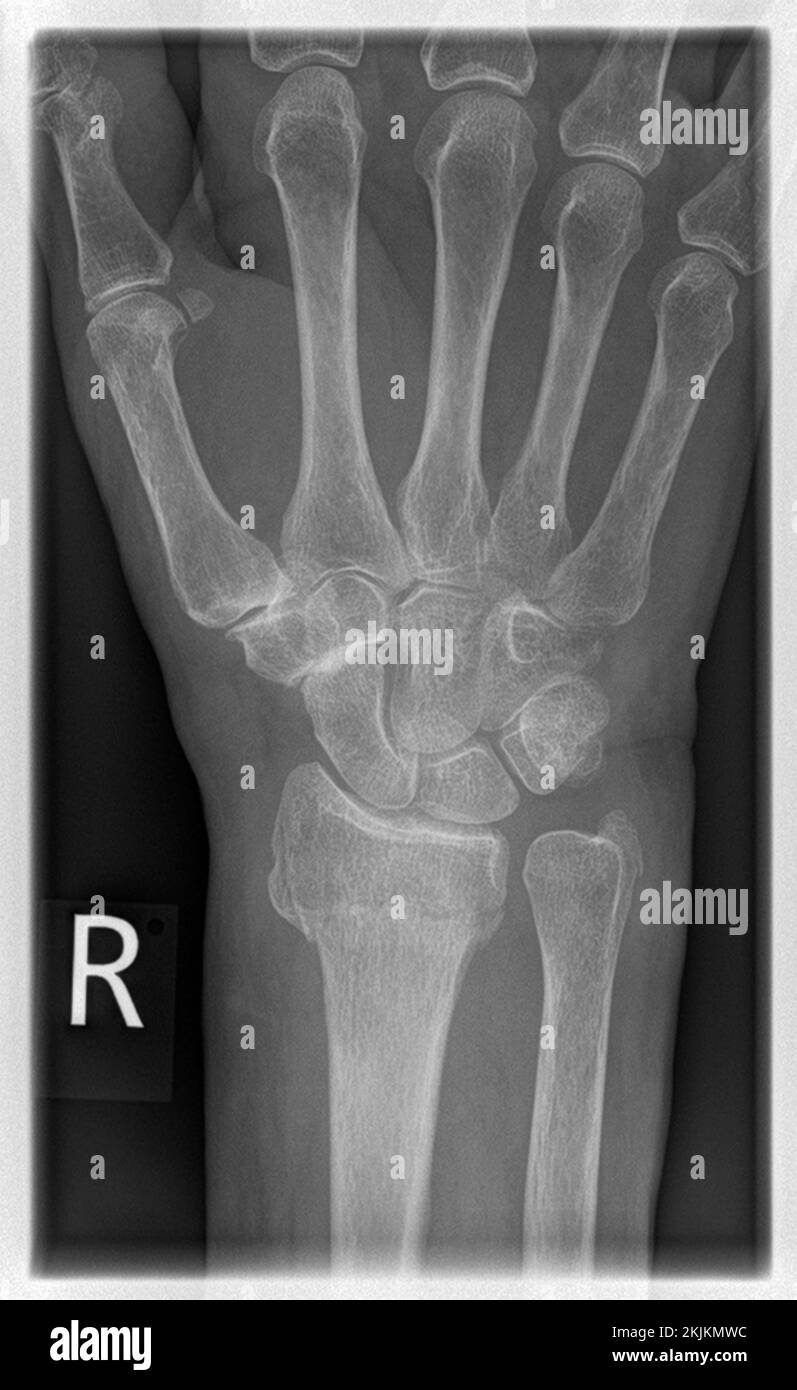 Radiografia di un paziente con frattura distale radiale a destra con avulsione PSU Foto Stock