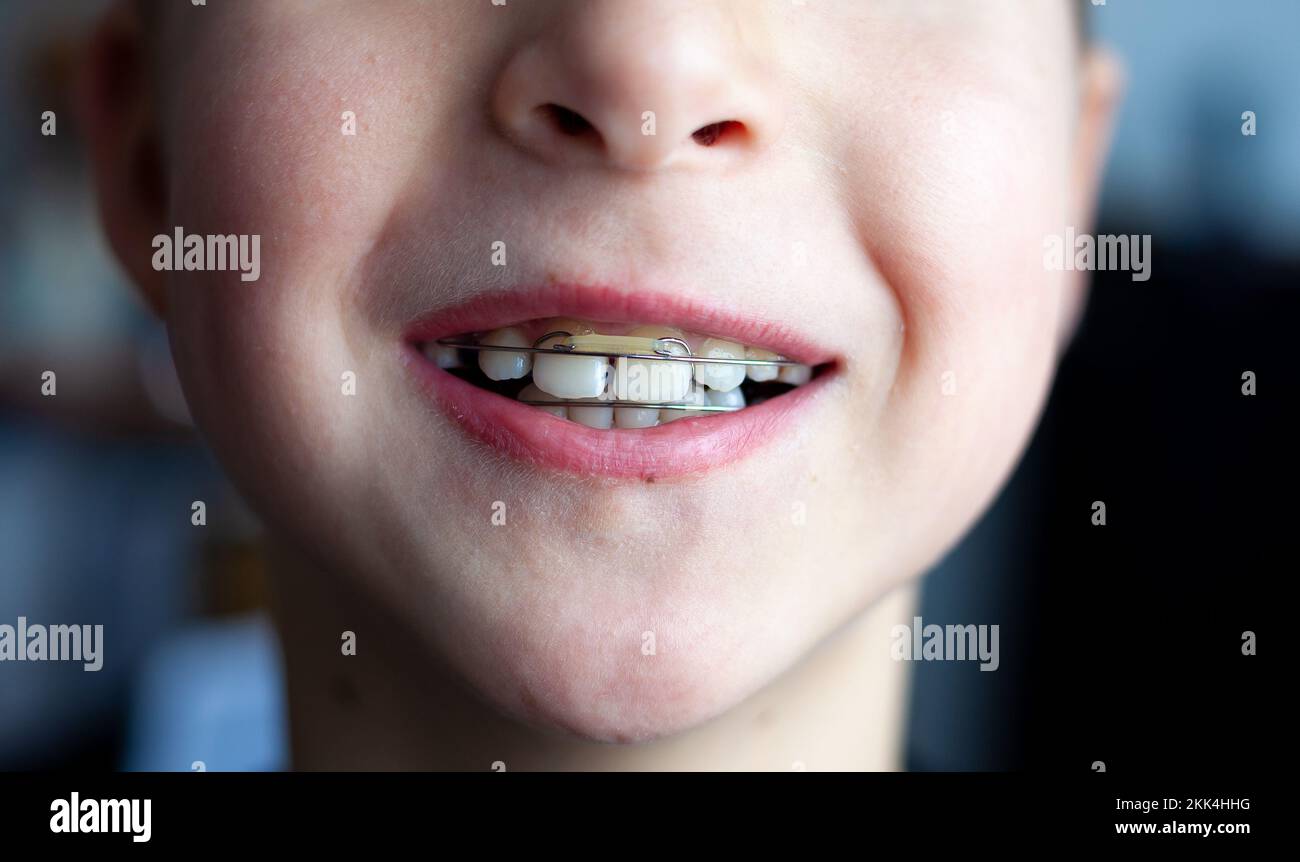 Piatti ortodontisti sui denti dei bambini. Allineamento dei morsi. Piastra ortodontica sulla mandibola superiore. Dente dei bambini. Foto Stock