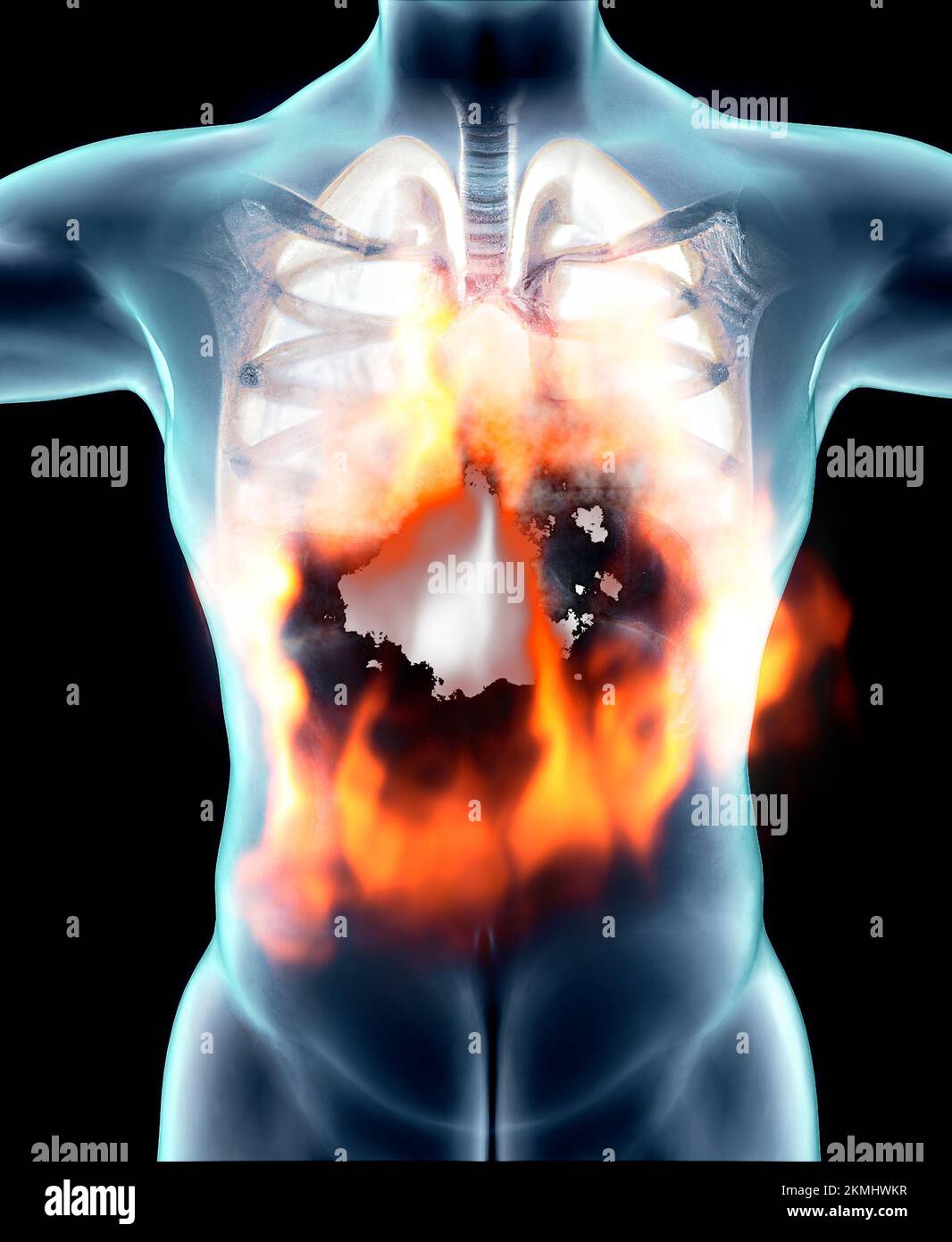 Anatomia umana, problemi al sistema respiratorio, polmoni gravemente danneggiati. Polmonite bilaterale. Covid-19, coronavirus. Paziente e fumo. Fumatore Foto Stock