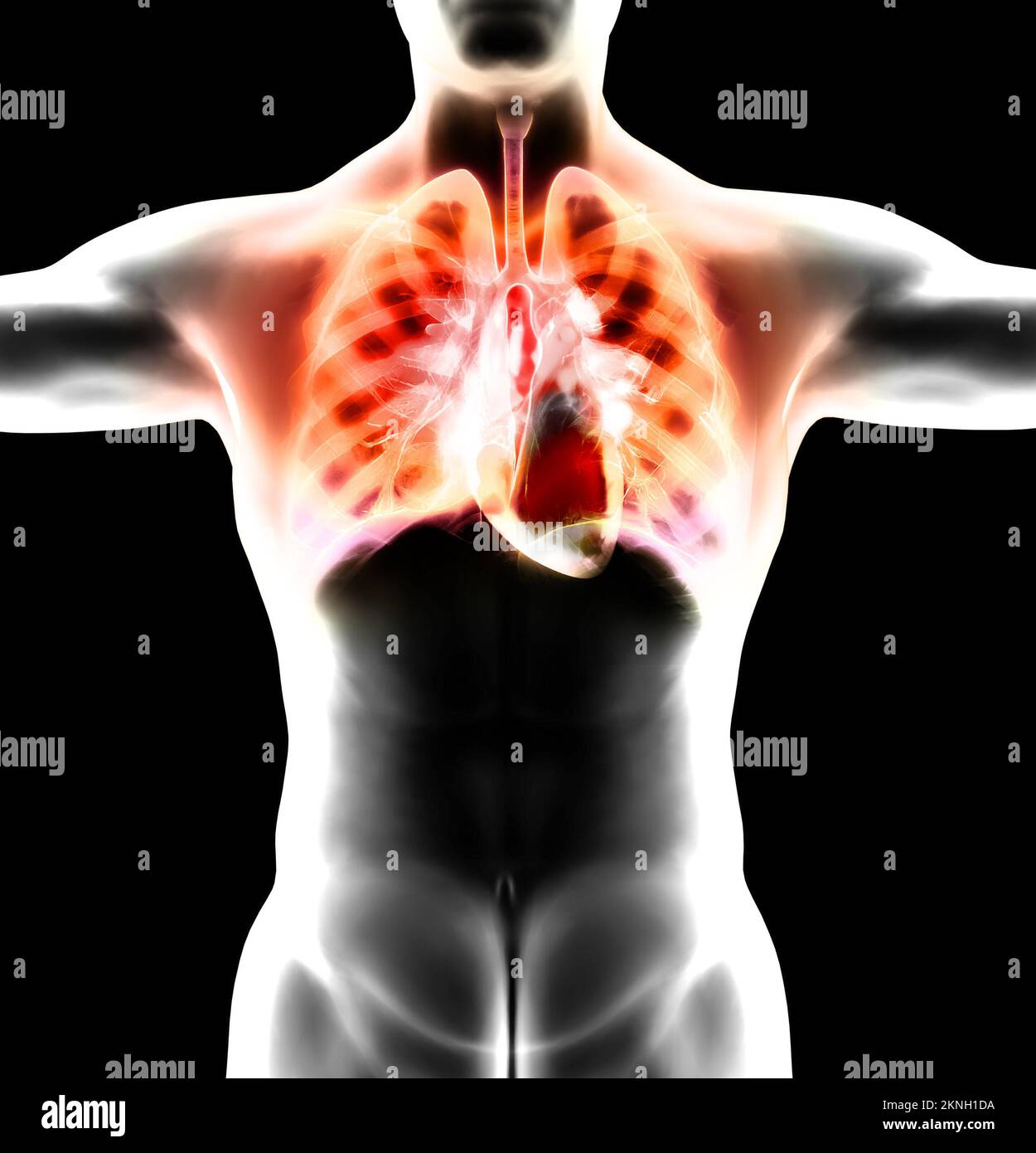 Anatomia umana, problemi al sistema respiratorio, polmoni gravemente danneggiati. Polmonite bilaterale. Covid-19, coronavirus. Paziente e fumo. Fumatore Foto Stock