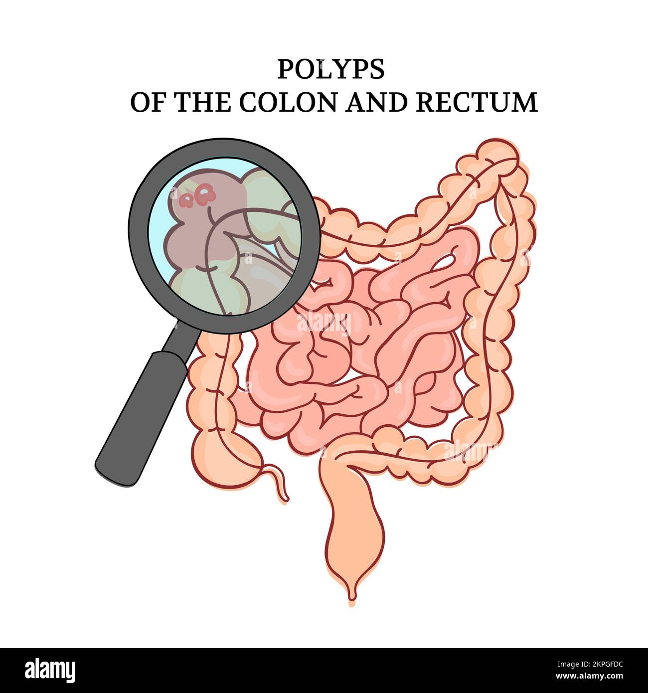 POLIPI DELL'INTESTINO DEL COLON Medicina Anatomia Università studente Scuola Istruzione Schema di insegnamento Cartoon umano mano disegnata clip Art Vector Illustrat Illustrazione Vettoriale