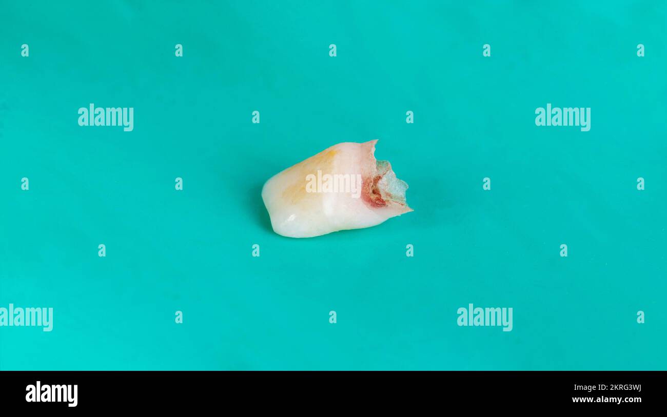 Dente di latte per bambini su sfondo verde, macro. Odontoiatria pediatrica, estrazione dei denti del latte nei bambini. Foto Stock