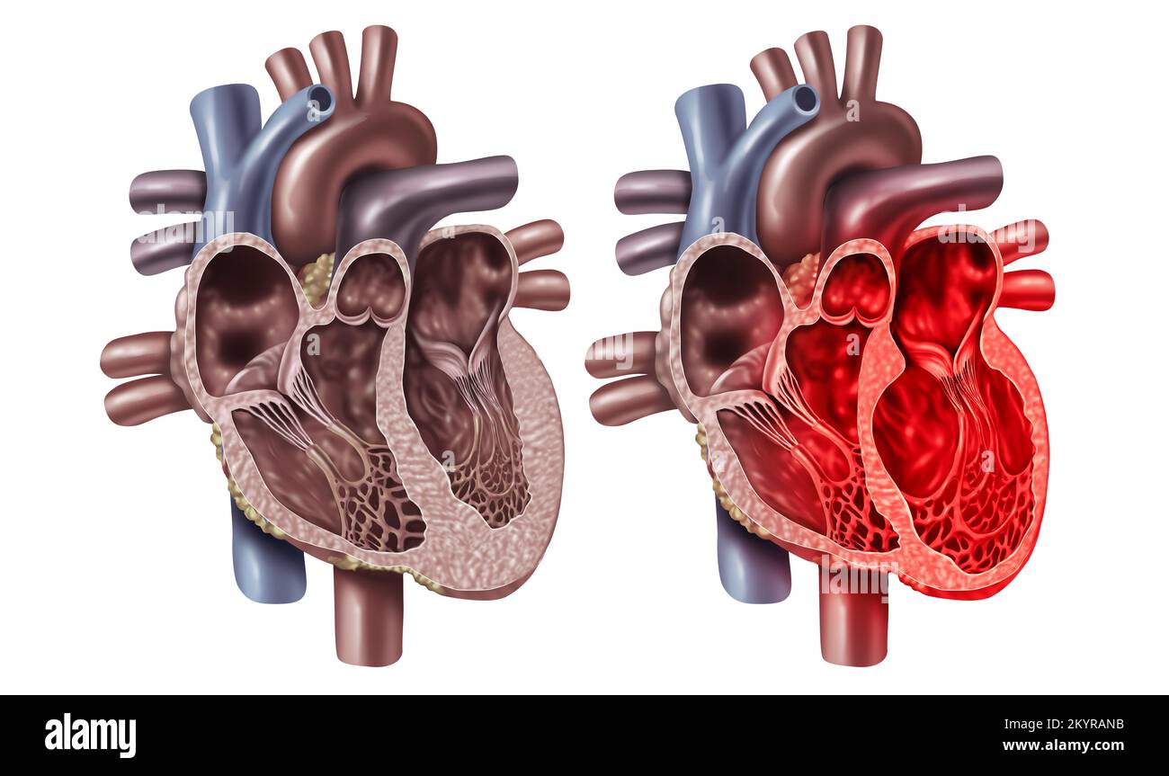Sindrome del cuore spezzata o cardiomiopatia Takotsubo con un concetto di sezione trasversale di anatomia di un organo cardiovascolare interno Foto Stock