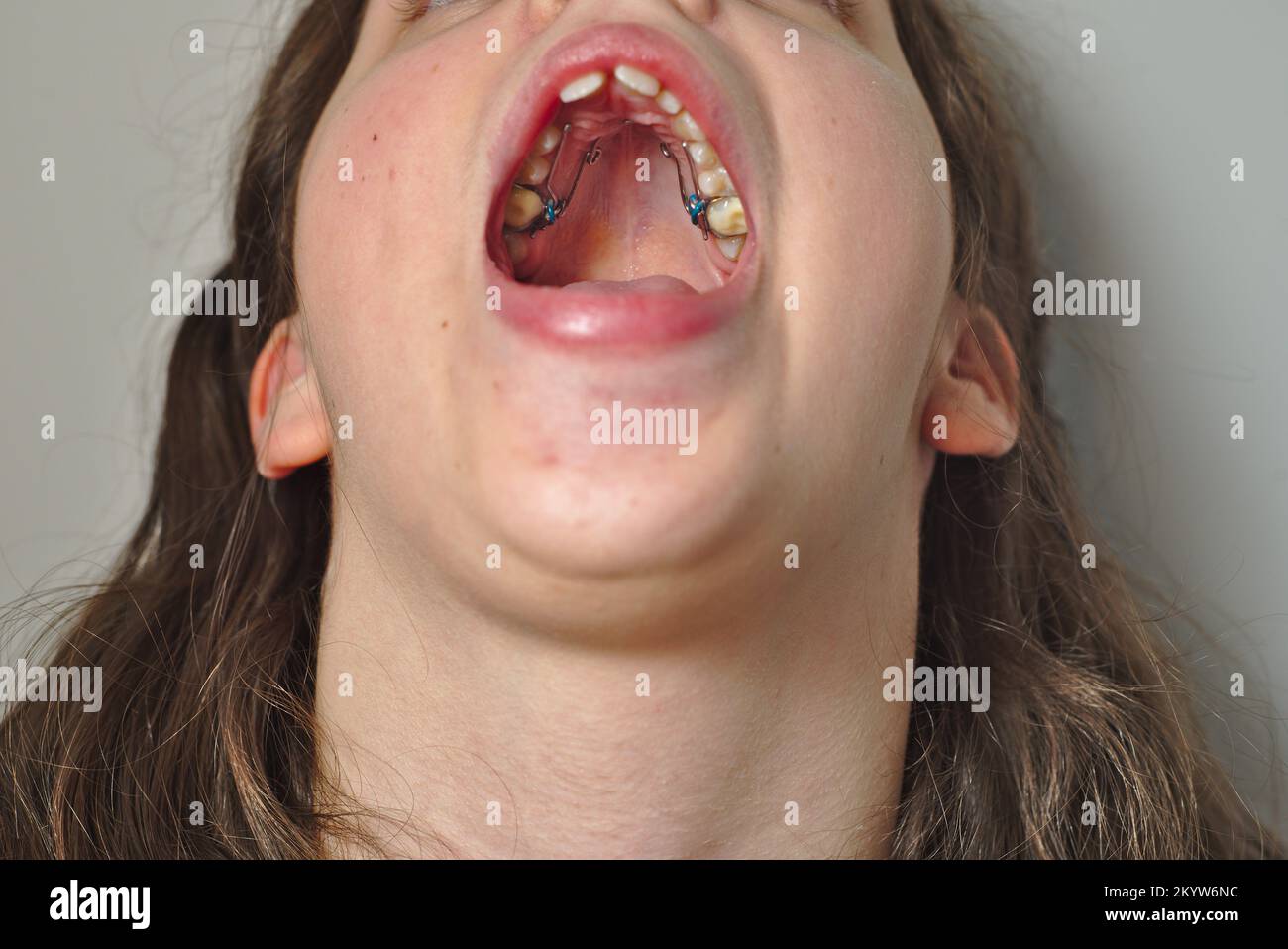 Un apparecchio ortodontico di espansione Quad Helix nella bocca di una ragazza adolescente Foto Stock