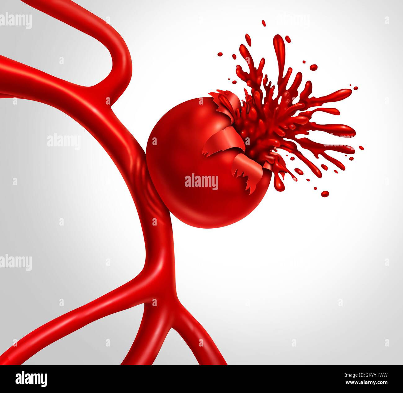 Aneurisma rotto come concetto medico con un vaso sanguigno gonfia come un'arteria palloncino con un sangue sanguinante rottura e causa Foto Stock