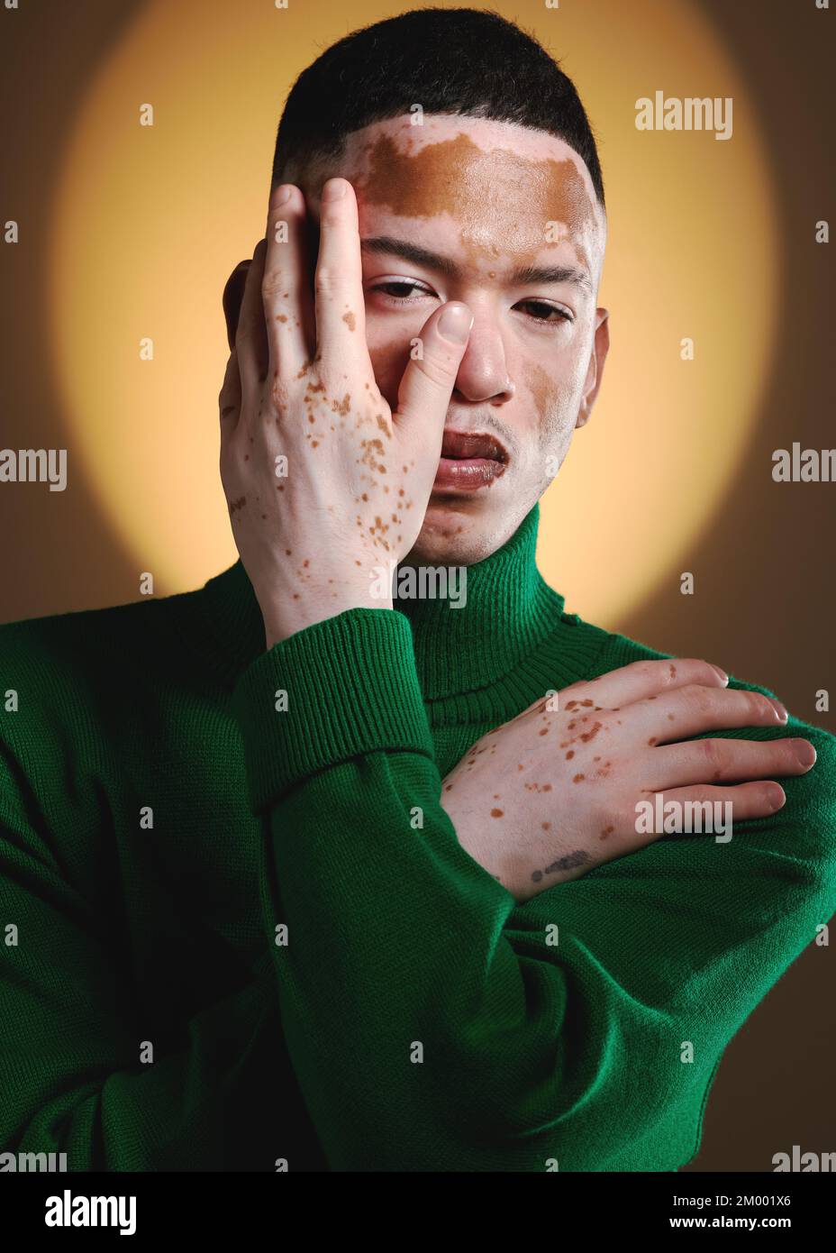 Vitiligo, uomo viso e modello di moda ritratto per il lusso di bellezza, stile e marchio designer. Pigmentazione della pelle, posa della mano e modello in posa per costoso Foto Stock