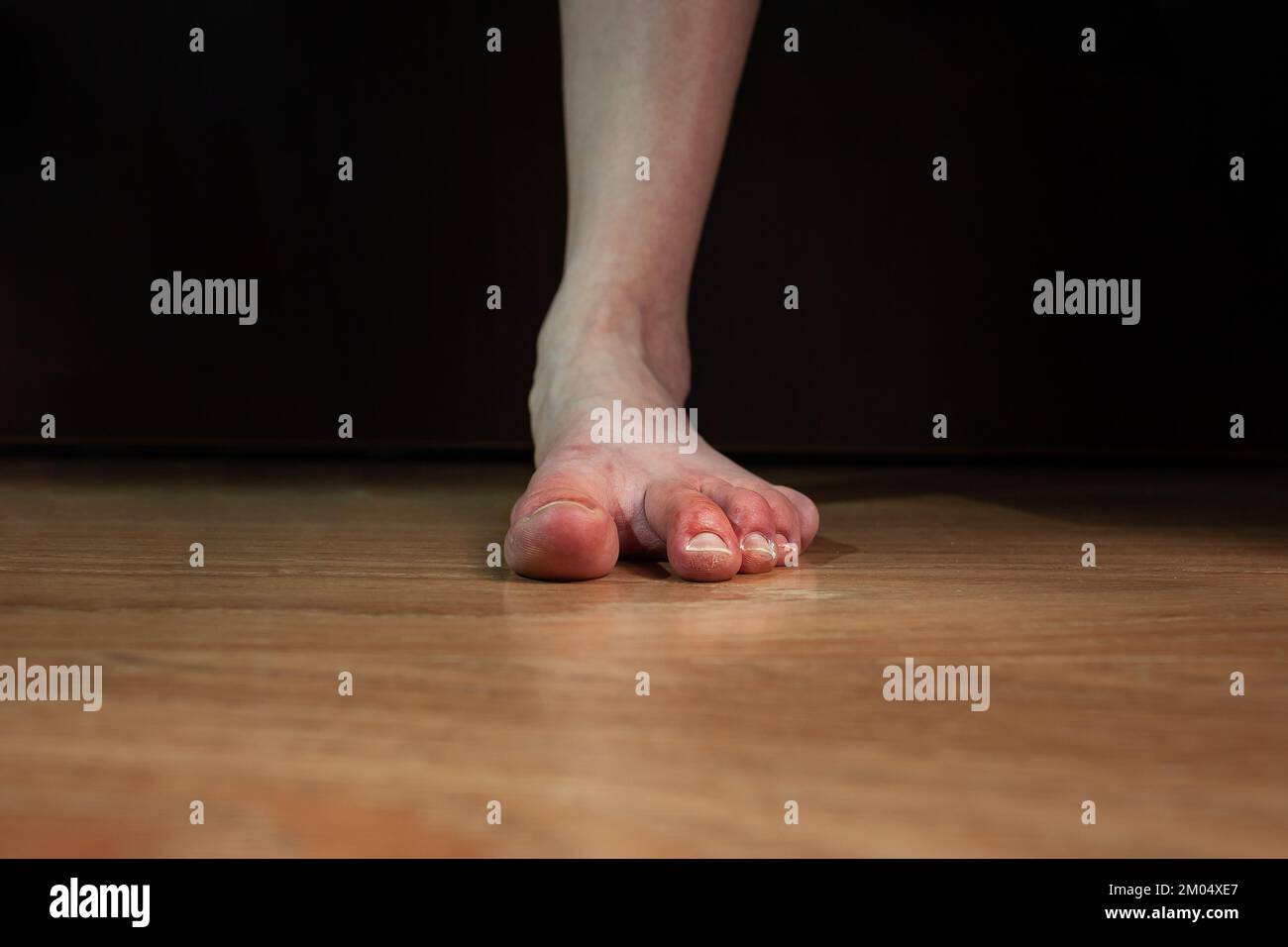 Piede di persona con fenomeno di Raynaud e piede piatto, con chillblains e dita gonfie rosse, pelle molto secca, danneggiata piede piatto su sfondo scuro Foto Stock