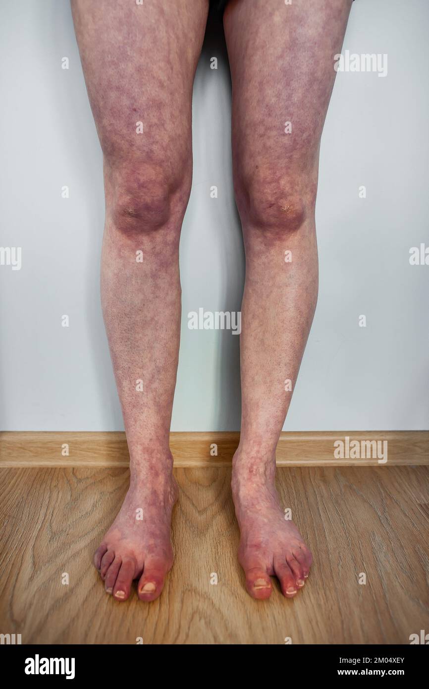 Sindrome da intolleranza ortostatica alterazione del colore viola delle gambe in posizione eretta, livedo reticularis, disautonomia del sangue che si raggruppa nelle gambe Foto Stock
