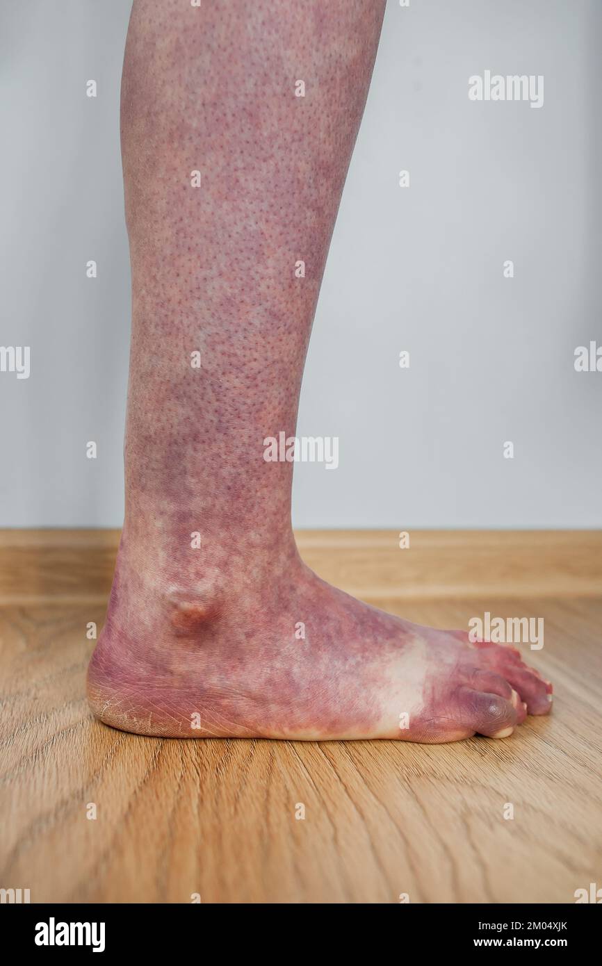 Gamba di persona con sindrome da intolleranza ortostatica con scolorimento viola in posizione eretta, sangue di disautonomia che si raggruppa nelle gambe livedo reticularis Foto Stock