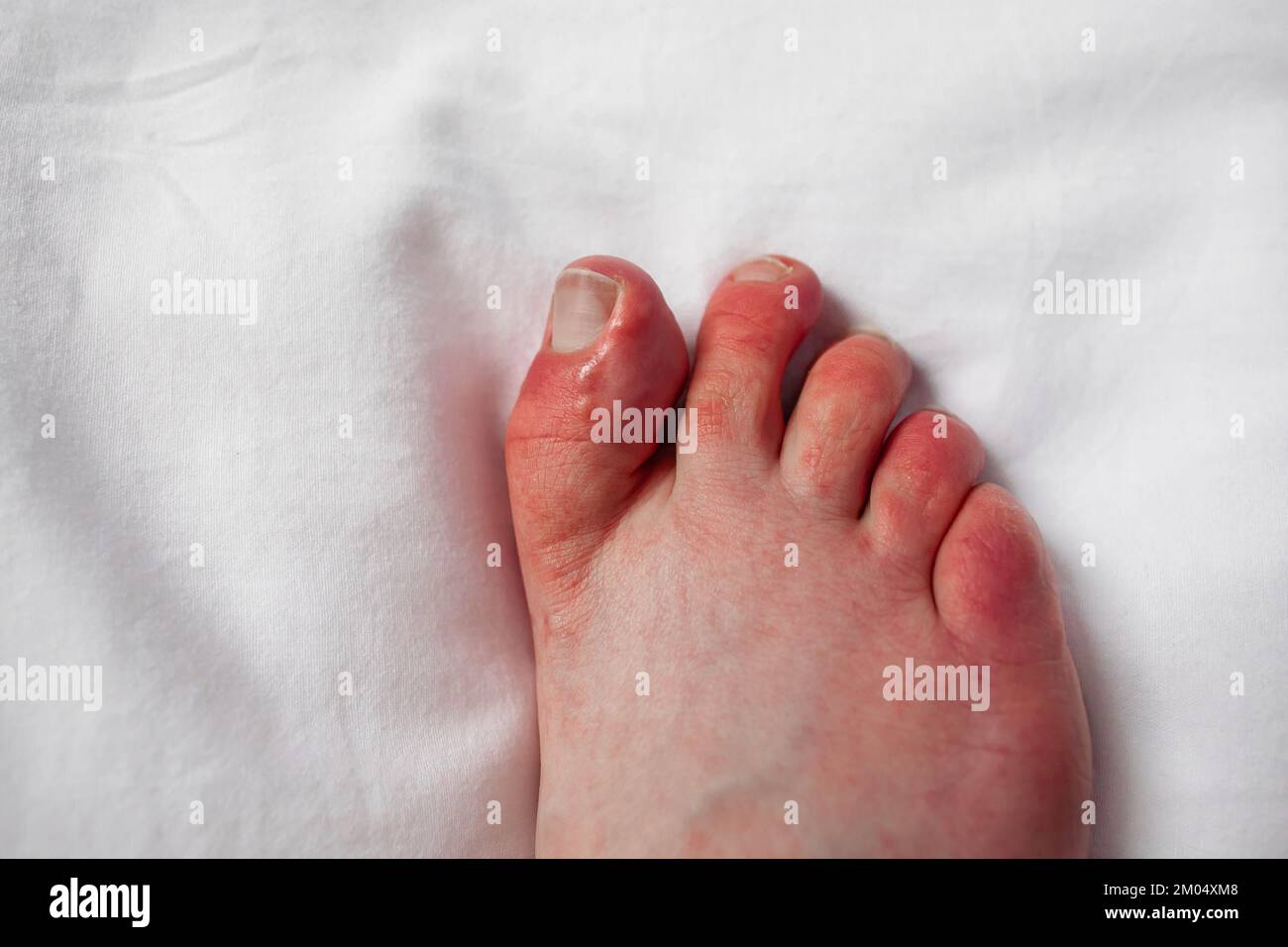 Bambini sulle dita dei piedi, rossore pruriginoso, gonfiore del piede della persona con fenomeno di Raynaud e lesioni dei bambini dermatite pernio sulle dita Perniosi Foto Stock