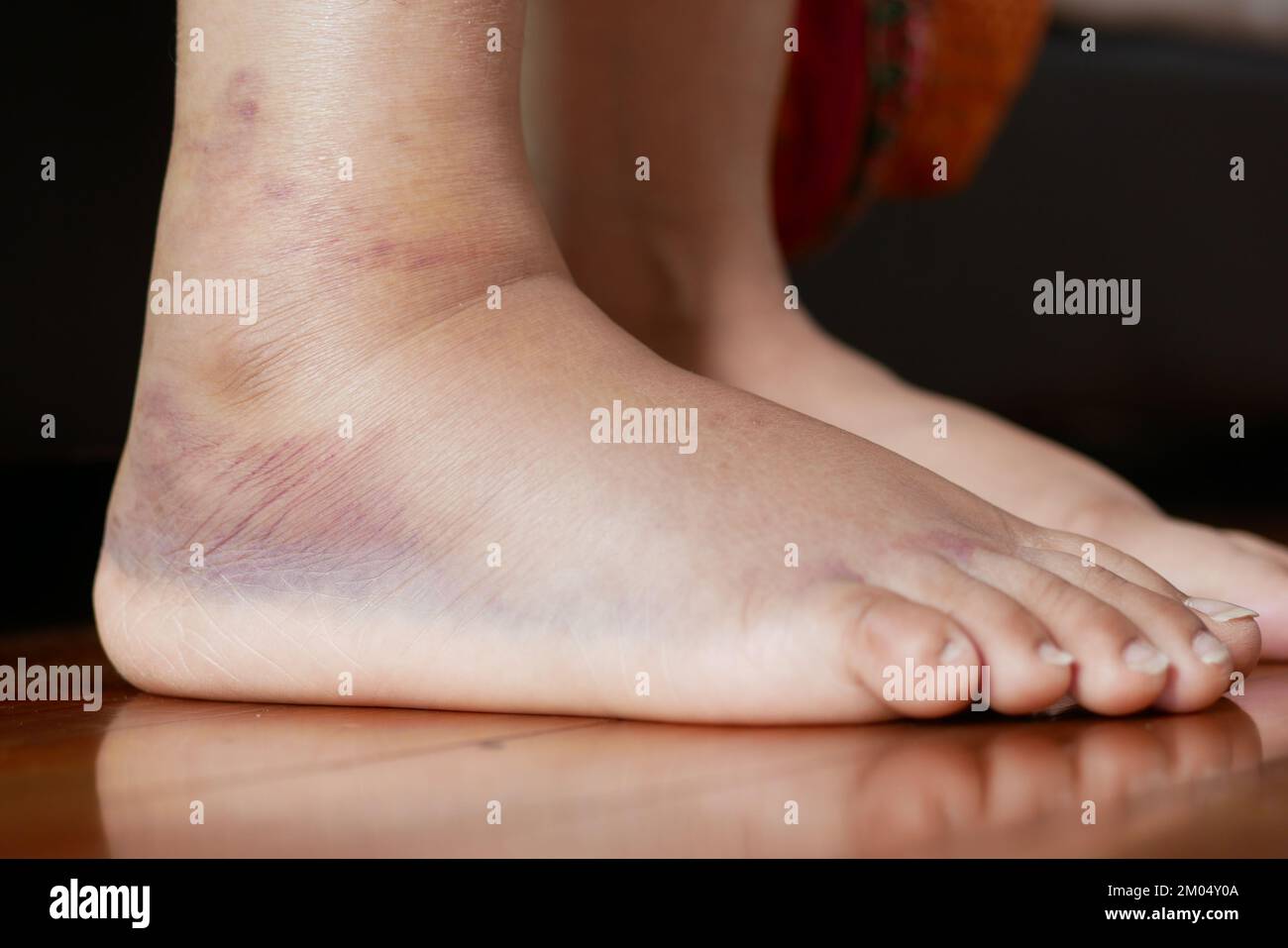 primo piano dei piedi delle donne con gonfiore Foto Stock