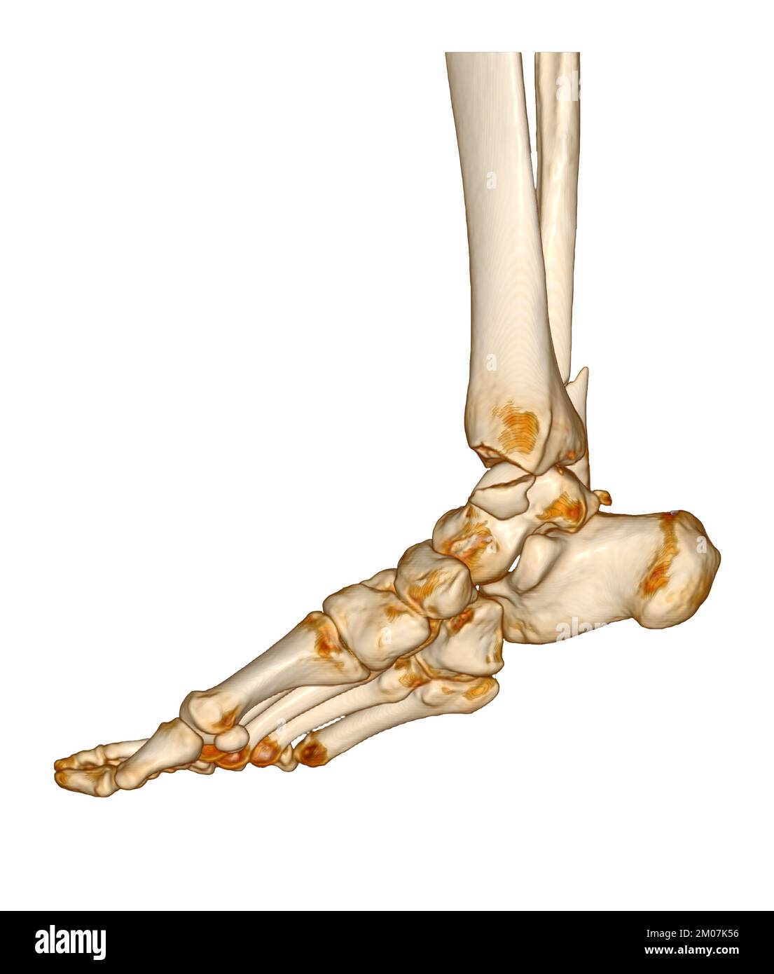 TC eseguire la scansione di caviglia e piede o tomografia computerizzata dell'articolazione della caviglia e del piede immagine 3Drendering che mostra la frattura della tibia e della fibula. Foto Stock