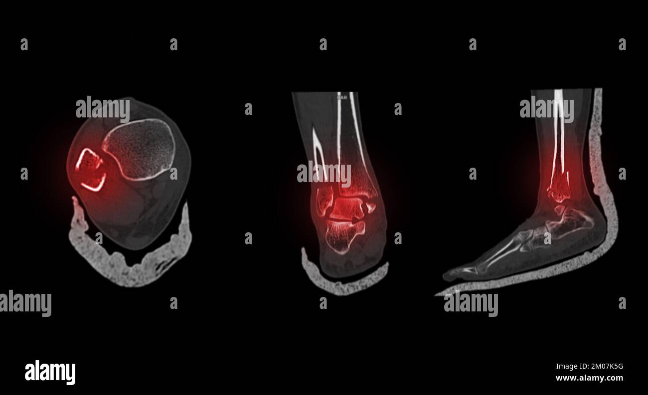 TC eseguire la scansione di caviglia e piede o tomografia computerizzata dell'articolazione della caviglia e del piede immagine 3Drendering che mostra la frattura della tibia e della fibula. Foto Stock