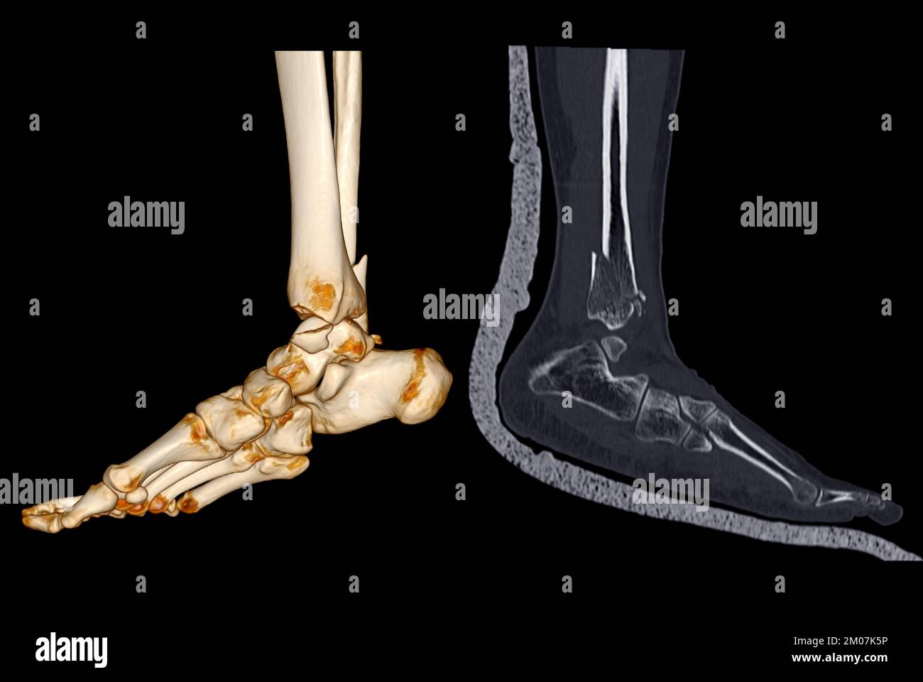 TC eseguire la scansione di caviglia e piede o tomografia computerizzata dell'articolazione della caviglia e del piede immagine 3Drendering che mostra la frattura della tibia e della fibula. Foto Stock