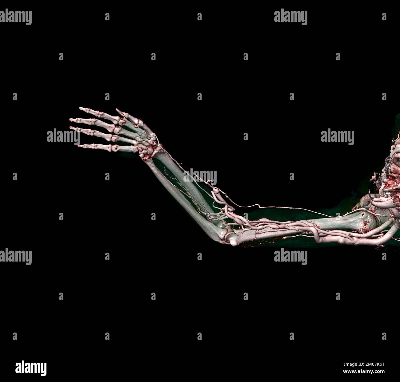 Arterie brachiali del braccio con rendering 3D dell'osso dell'estremità superiore dallo scanner TC. Foto Stock