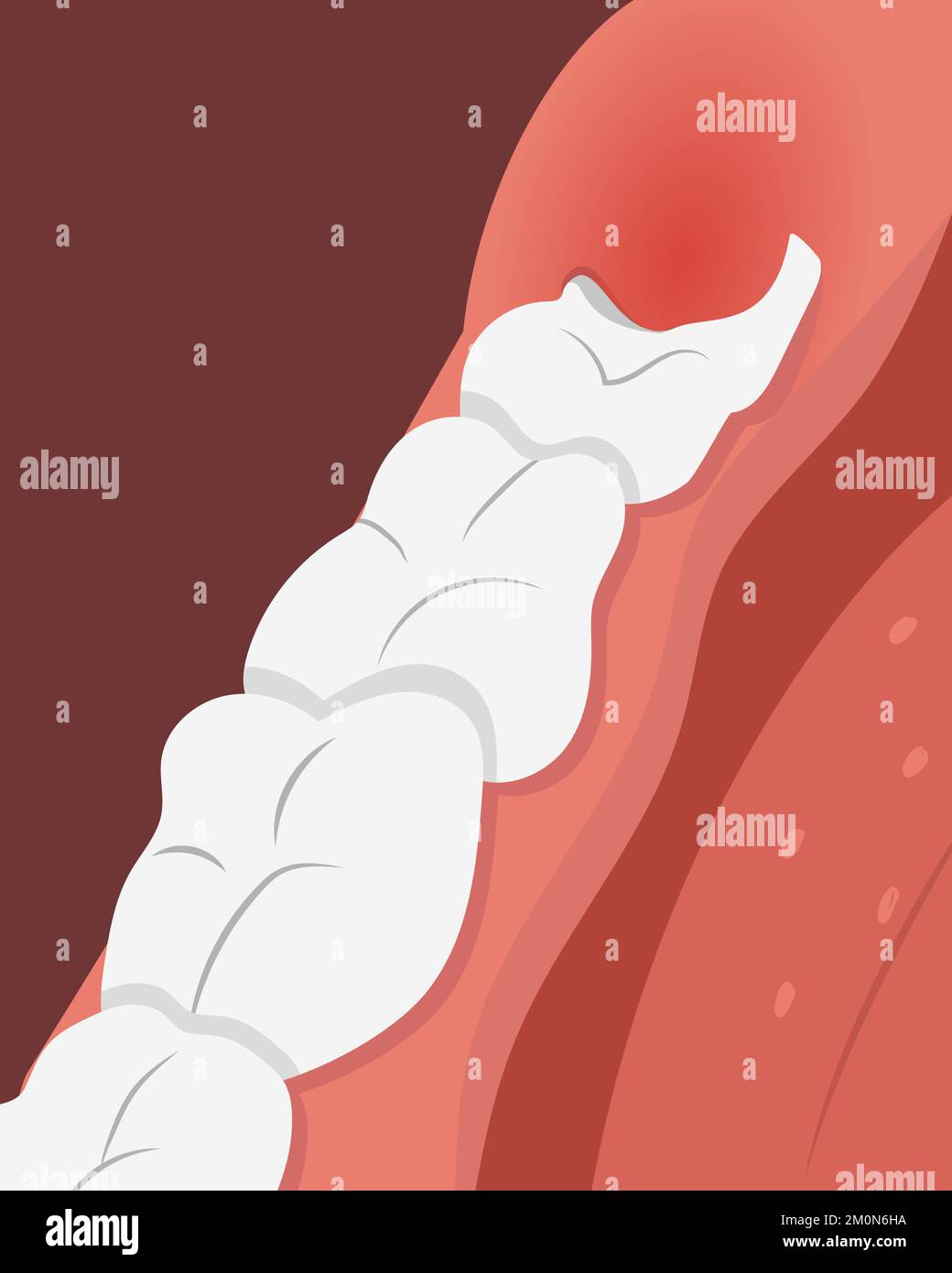 Illustrazione della fila dei denti con la gomma infiammata sopra il dente crescente di saggezza. Illustrazione Vettoriale