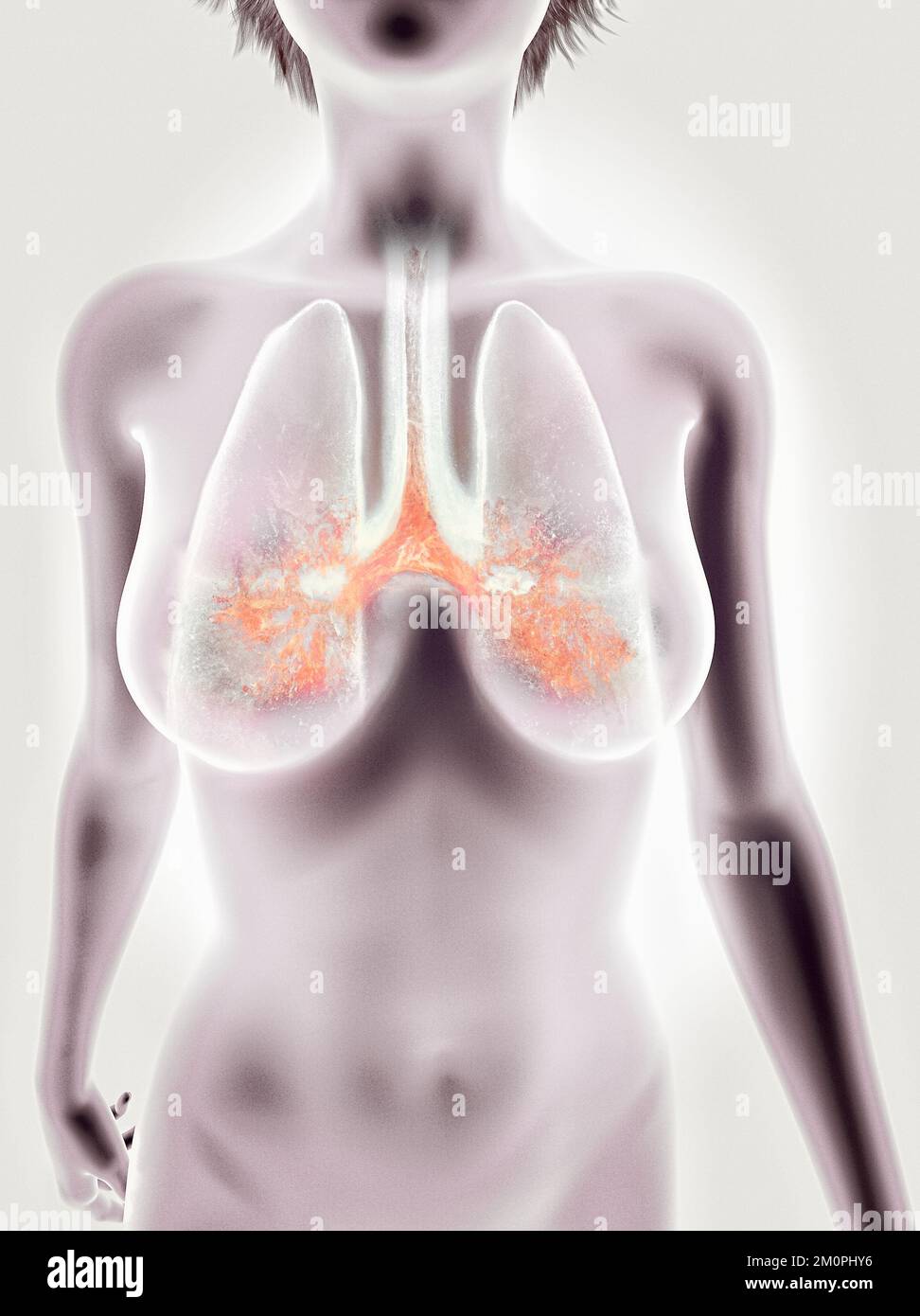 Anatomia umana, problemi al sistema respiratorio, polmoni gravemente danneggiati. Polmonite bilaterale. Covid-19, coronavirus. Paziente e fumo. Fumatore. Foto Stock