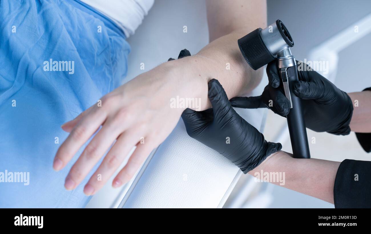 Un dermatologo esamina la talpa di un paziente attraverso un dermatoscopio. Foto Stock