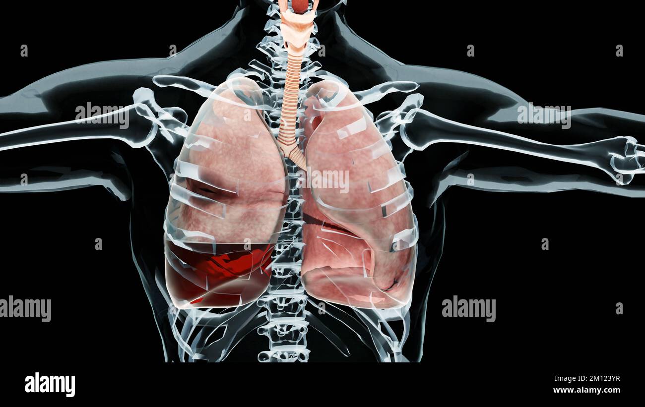 3D Illustrazione di emopneumotorace, polmone normale versus collassato, sintomi di emopneumotorace, versamento pleurico, empyema, complicazioni dopo un attacco di secredi Foto Stock