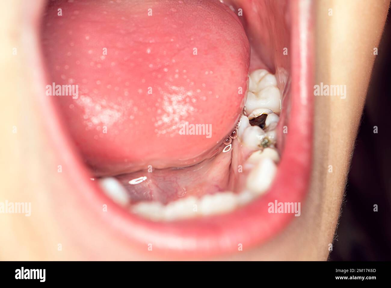 bocca aperta che mostra carie decadimento denti. una giovane ragazza ad un appuntamento dentista. denti dei bambini malati. Foto Stock