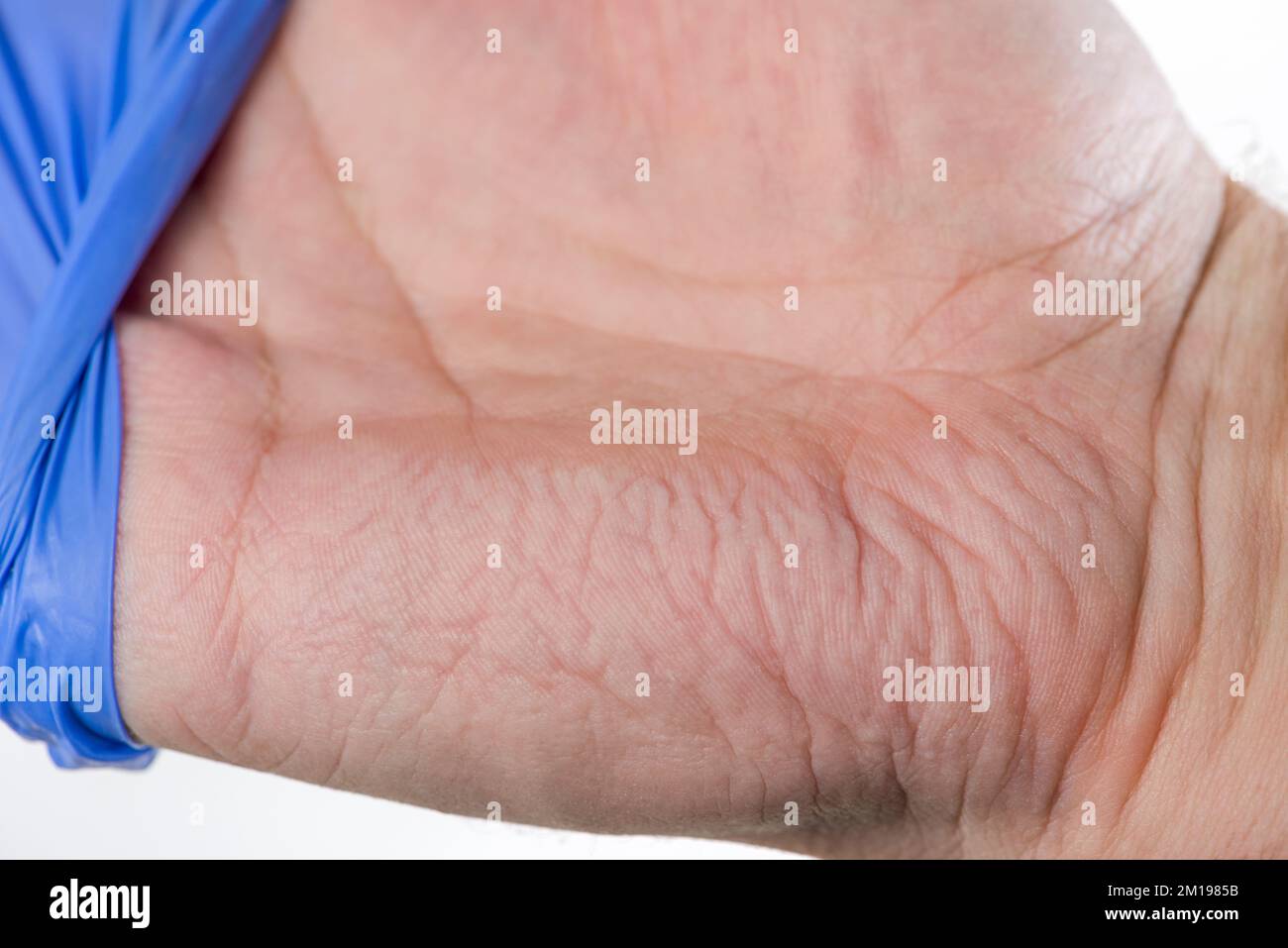 Il medico toglie i guanti di gomma blu, la pelle sulle mani è rugosa dall'umidità. Dita grinze dopo aver indossato guanti di gomma per un lungo periodo Foto Stock