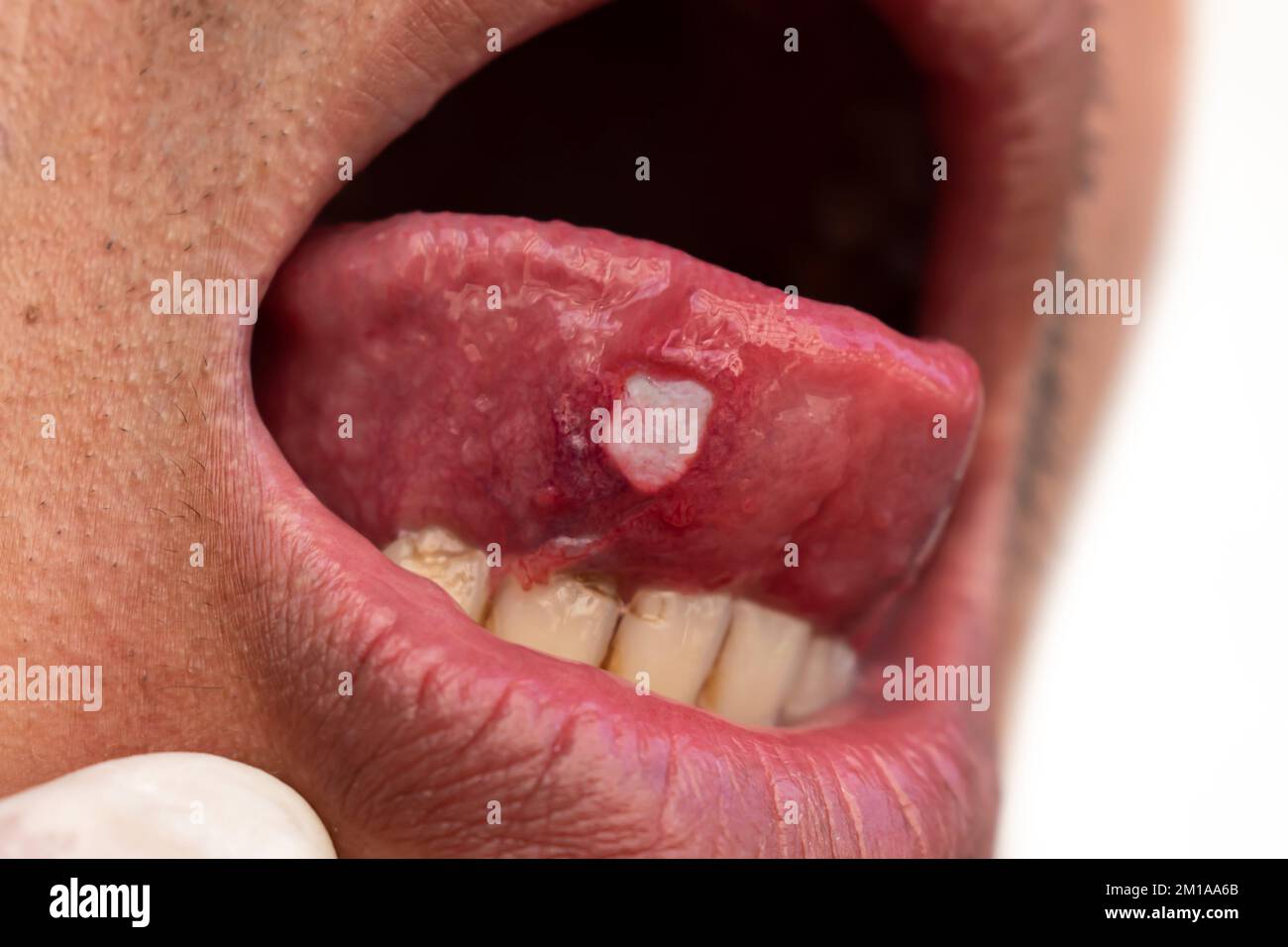Ulcera alla lingua di un paziente asiatico di sesso maschile. La diagnosi può essere un'ulcera aftosa, un dolore al canker, un'ulcera da stress o un cancro alla lingua. Foto Stock