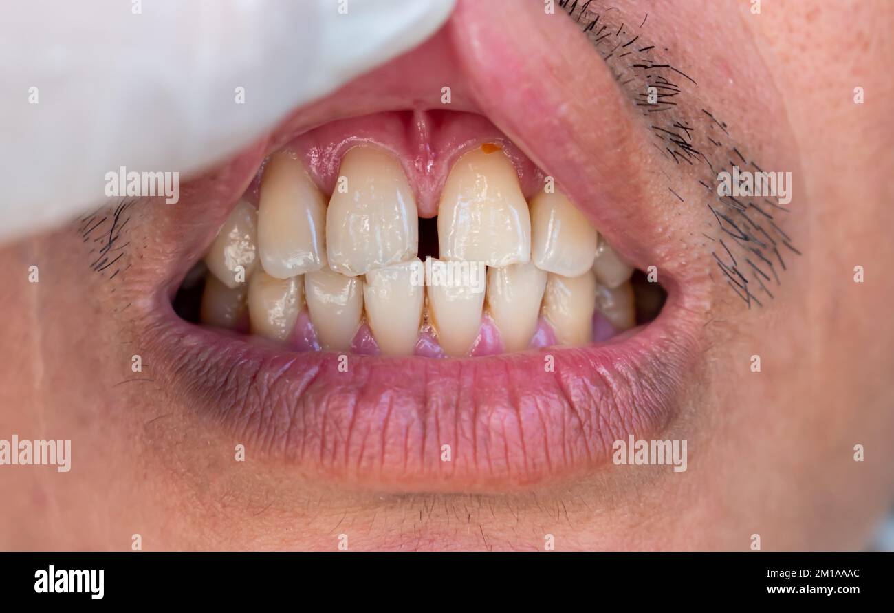 Enorme divario tra i denti anteriori o gli incisivi dell'uomo cinese asiatico. Diastema. Foto Stock