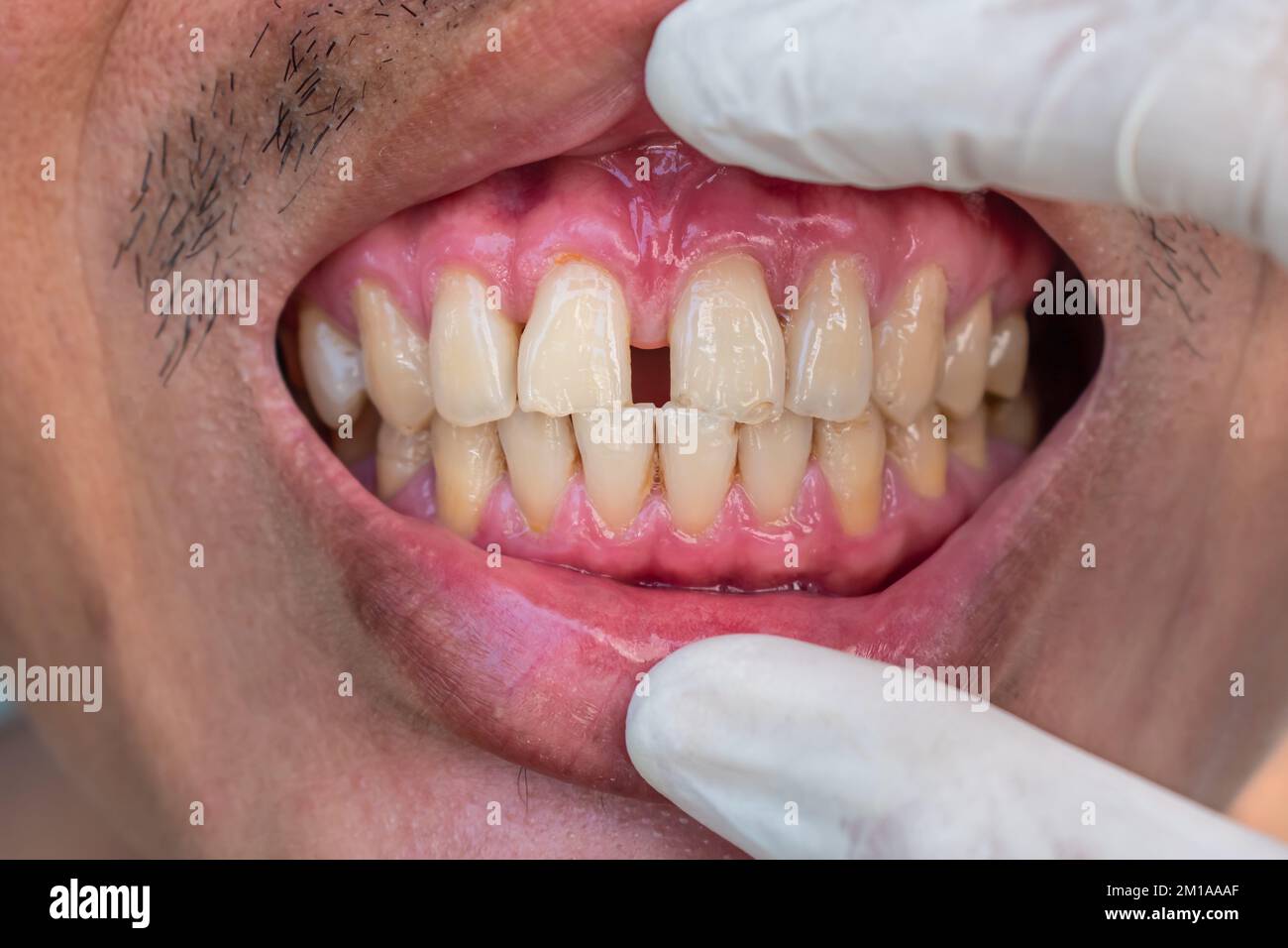 Enorme divario tra i denti anteriori o gli incisivi dell'uomo cinese asiatico. Diastema. Foto Stock