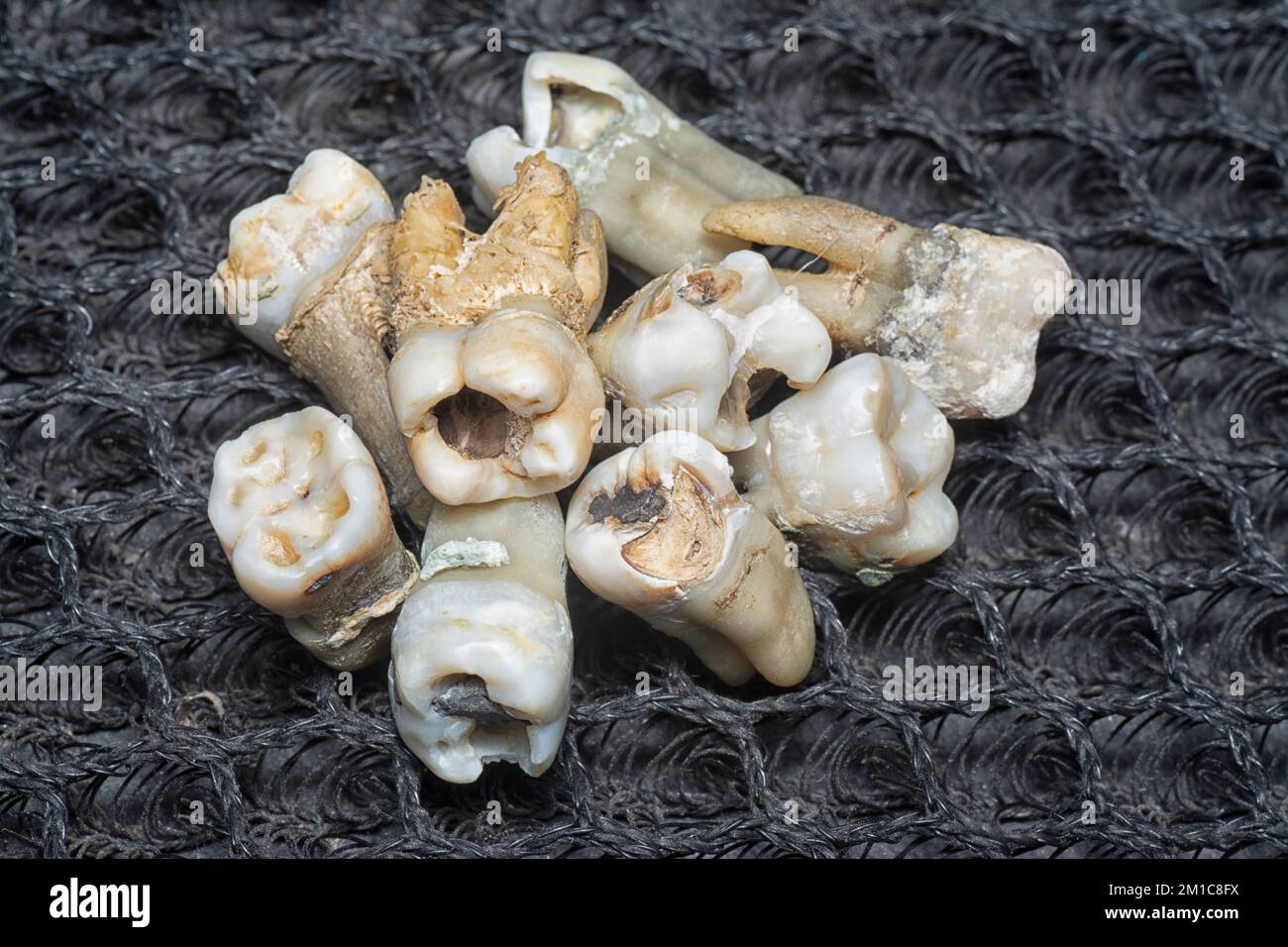 il fascio di denti umani di decadimento estratti indesiderati. Foto Stock