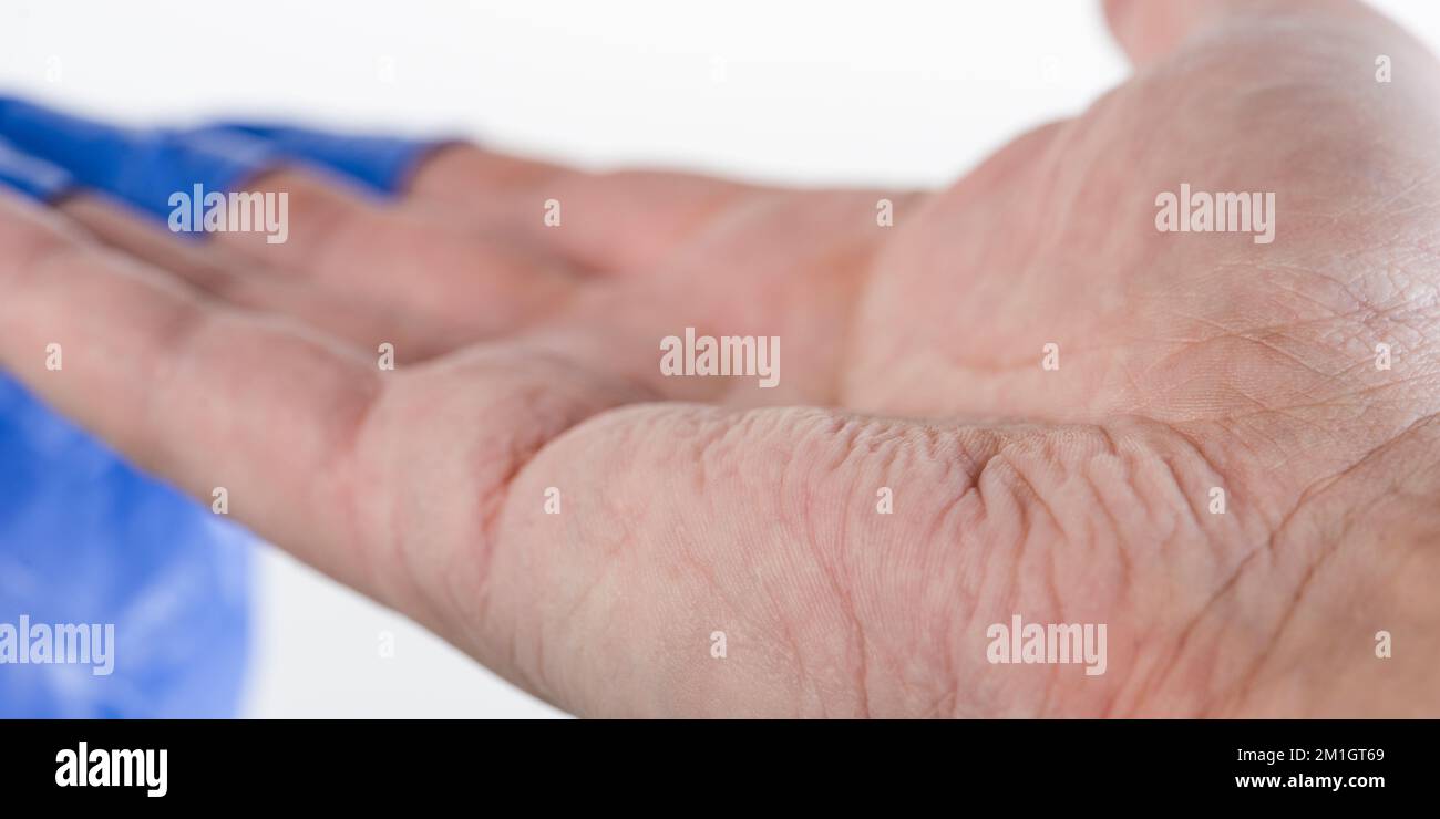 Il medico toglie i guanti di gomma blu, la pelle sulle mani è rugosa dall'umidità. Dita grinze dopo aver indossato guanti di gomma per un lungo periodo Foto Stock