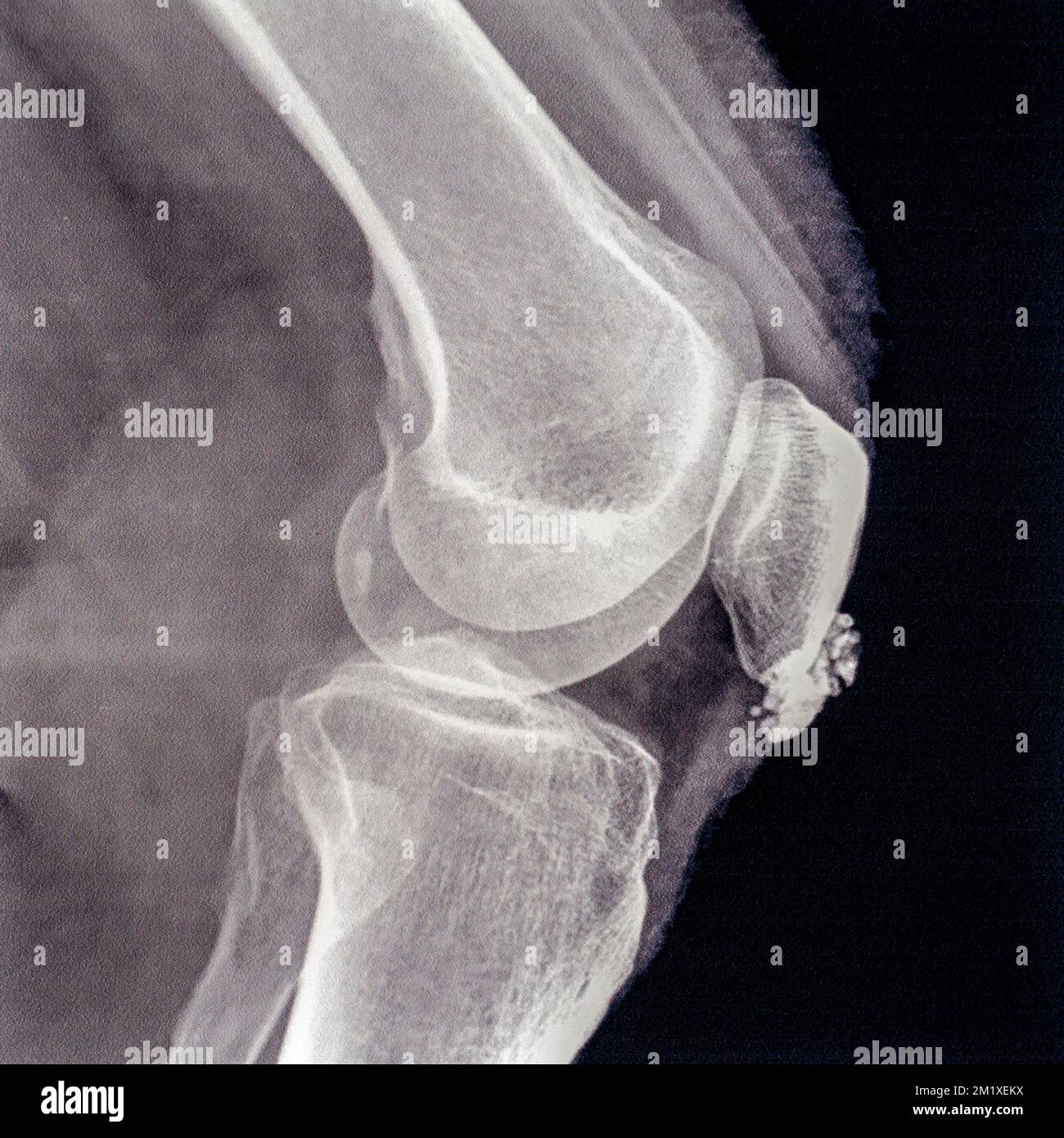 Metà del 20th ° secolo radiografia / radiografia che mostra la borsite nell'articolazione del ginocchio, infiammazione di una o più bursae di liquido sinoviale nel corpo Foto Stock