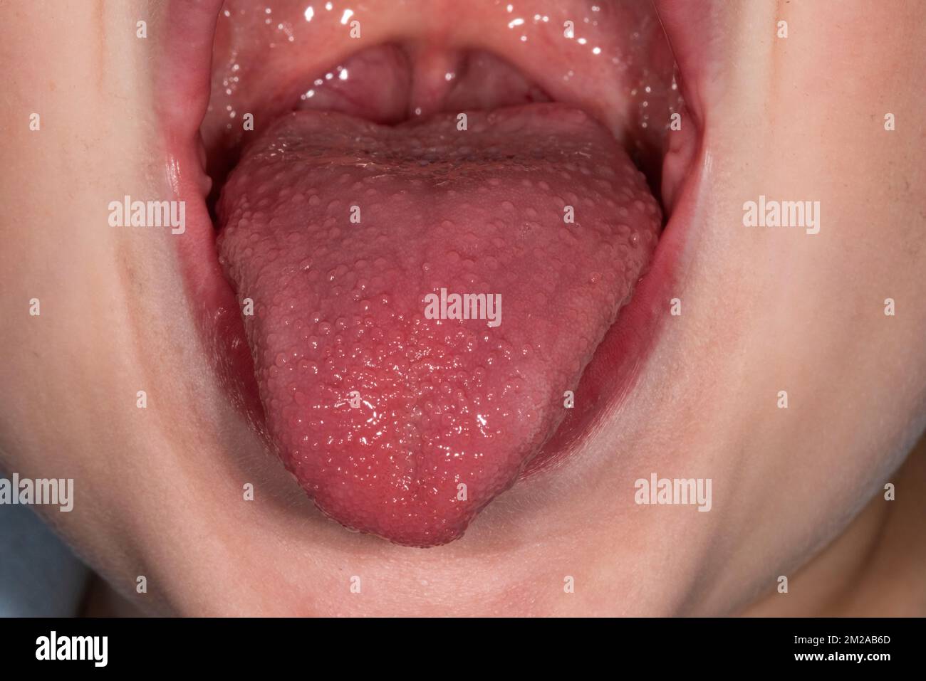 Lingua di fragola nella febbre scarlatta Foto Stock