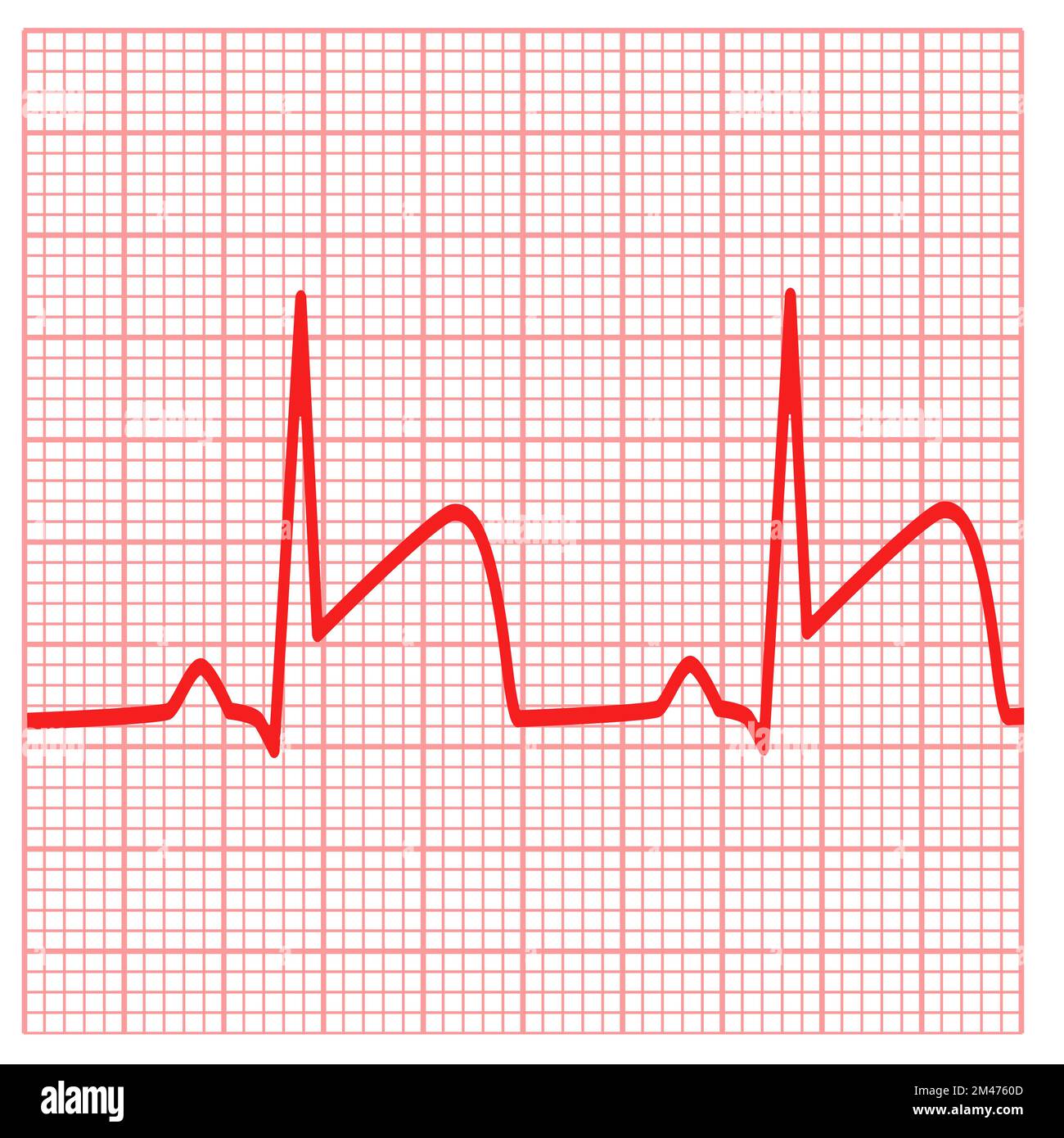 Mostra gli ECG per infarto miocardico. Segno di attacco cardiaco. simbolo  di trombosi dell'arteria coronaria. stile piatto Foto stock - Alamy