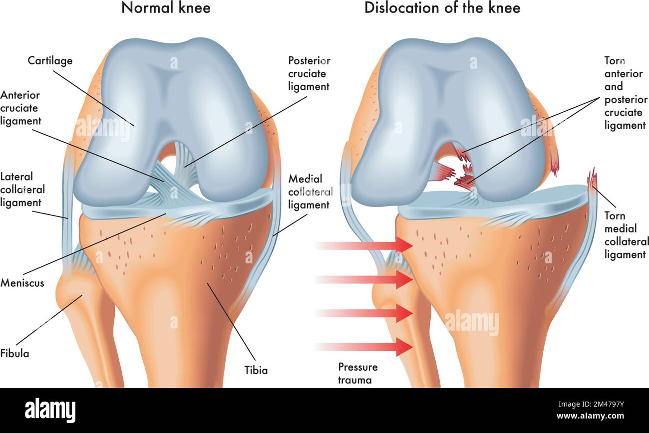 Illustrazione medica dei sintomi del ginocchio dislocato, con annotazioni. Illustrazione Vettoriale
